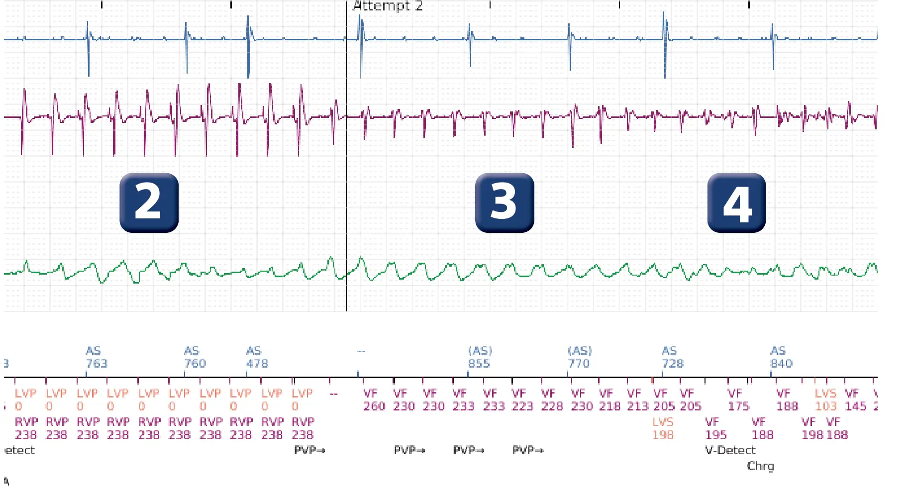 Boston Scientific ICD electrogram, segment 4 of 6 — Anti-tachycardia pacing in the VT zone with acceleration into the VF zone