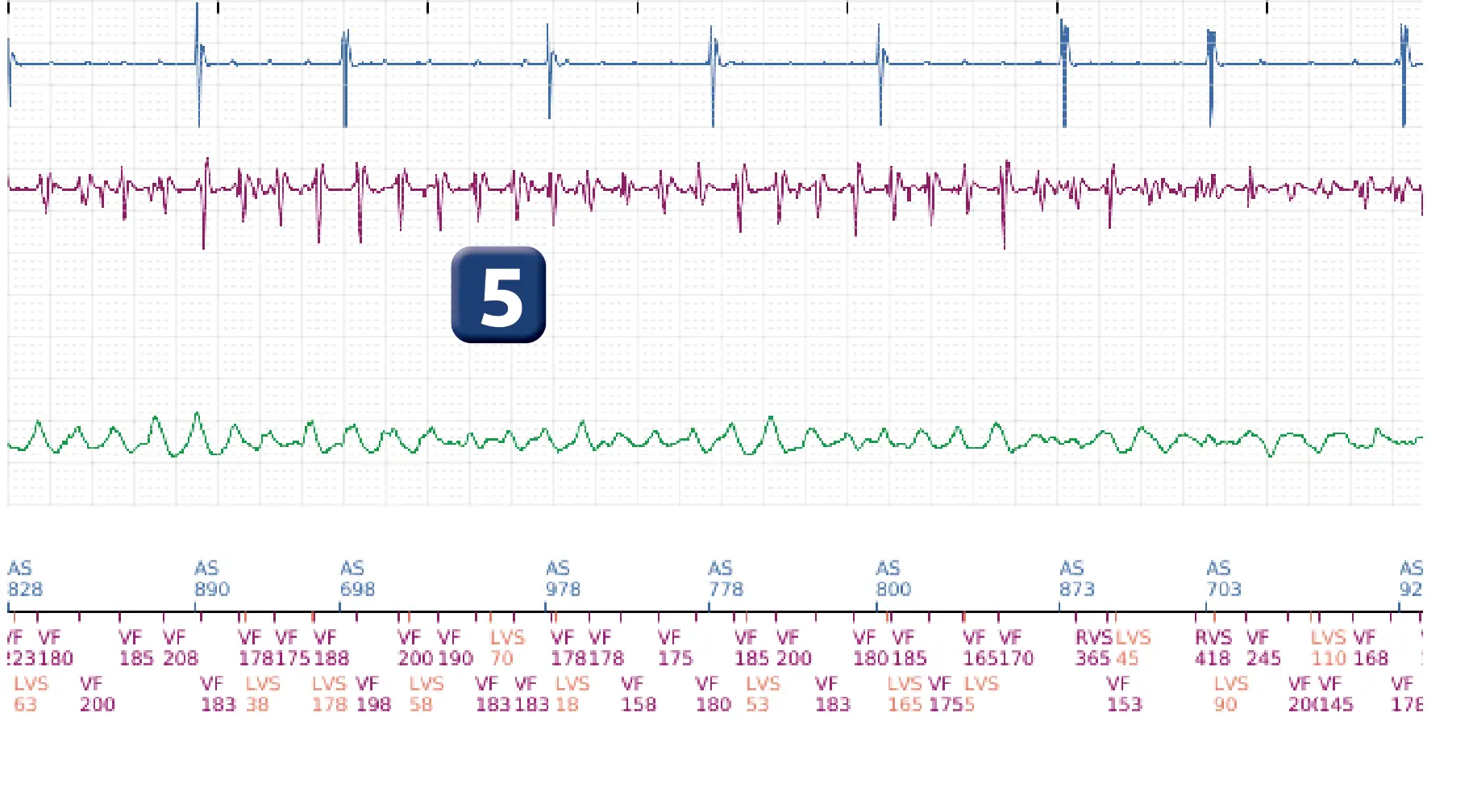 Boston Scientific ICD electrogram, segment 5 of 6 — Anti-tachycardia pacing in the VT zone with acceleration into the VF zone