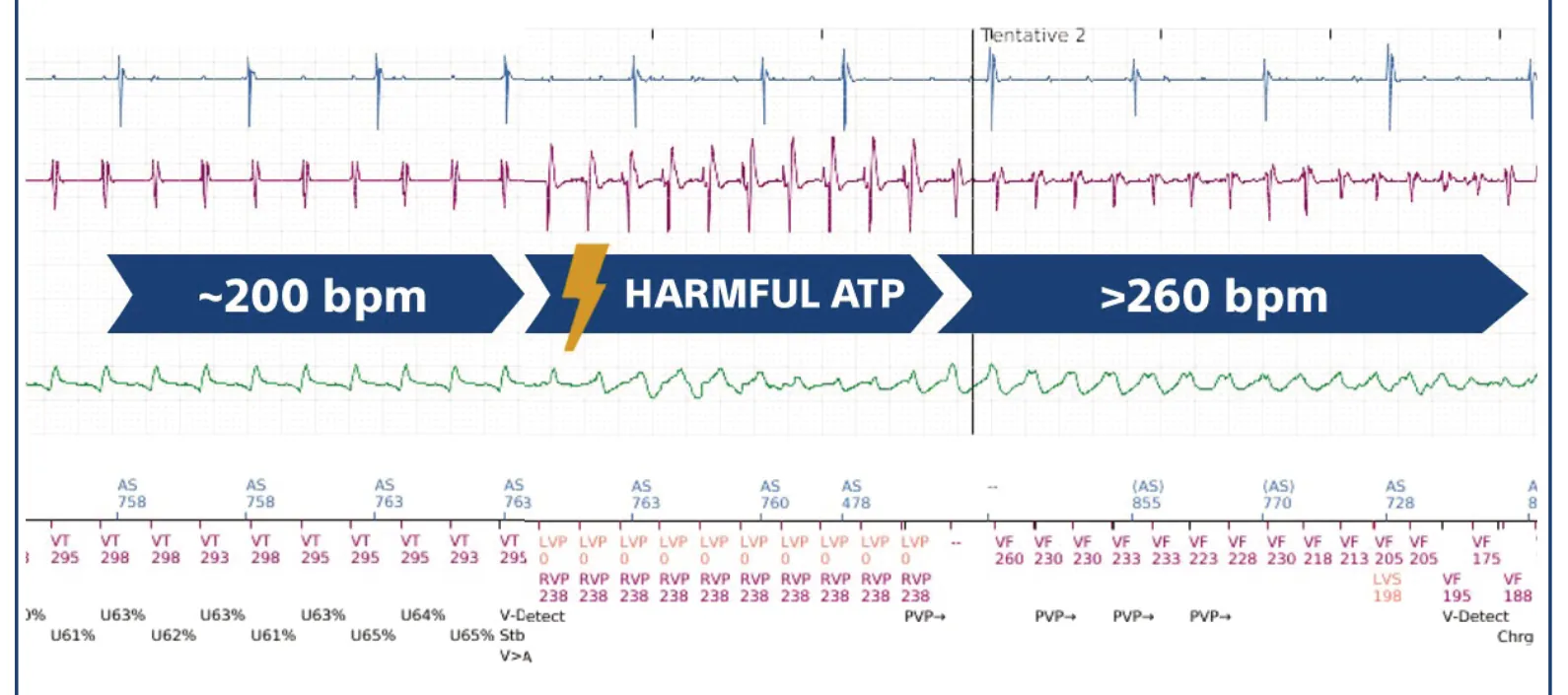 This figure shows how the anti-tachycardia pacing sequence accelerates a monomorphic VT at 200 beats/minute into a very rapid ventricular flutter and then into VF.