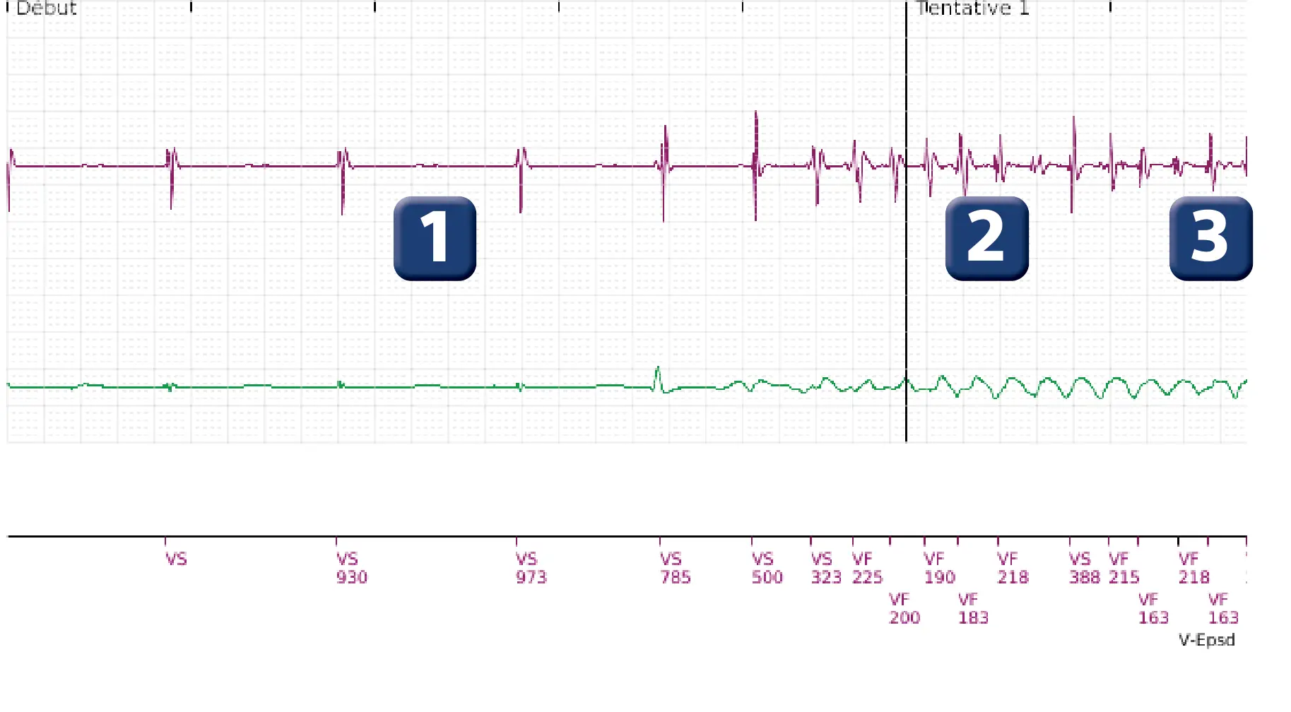 Boston Scientific ICD electrogram, segment 1 of 3 — VF episode with low-amplitude shock in a child