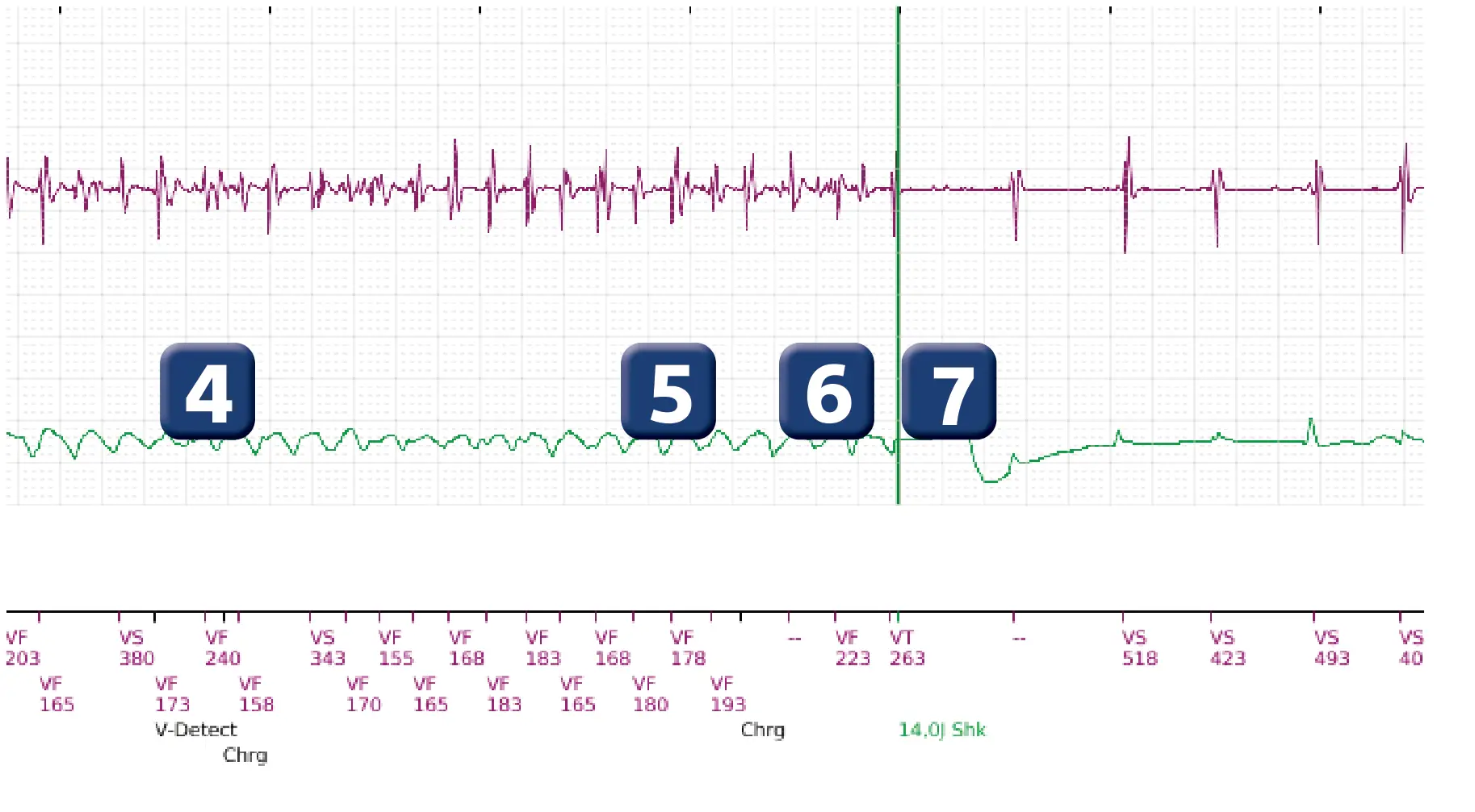 Boston Scientific ICD electrogram, segment 2 of 3 — VF episode with low-amplitude shock in a child