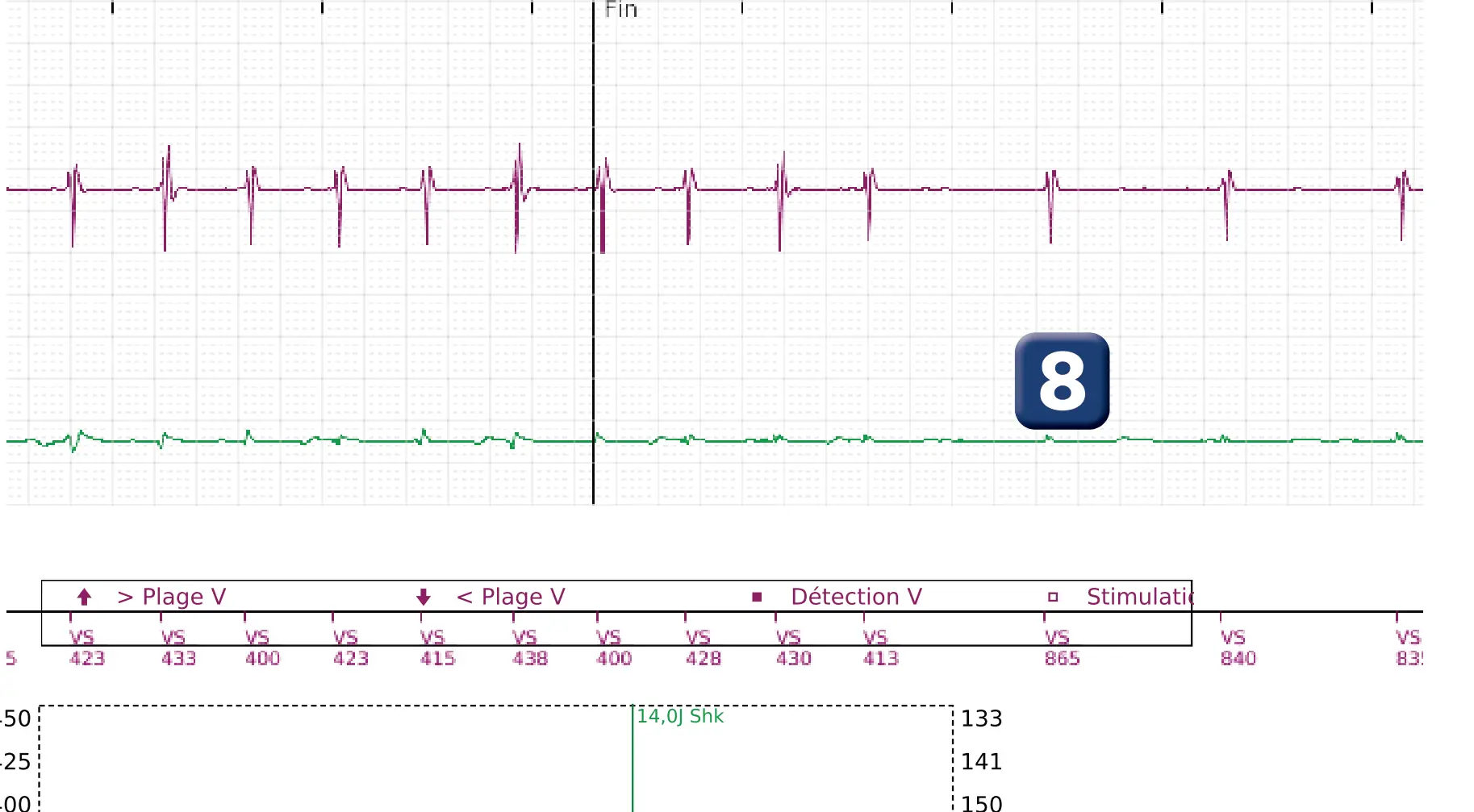 Boston Scientific ICD electrogram, segment 3 of 3 — VF episode with low-amplitude shock in a child
