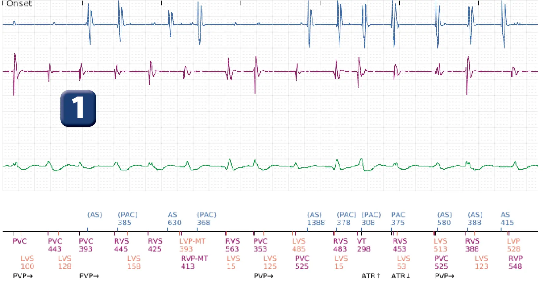 Boston Scientific ICD electrogram, segment 1 of 12 — Multiple electric shocks in the VF zone