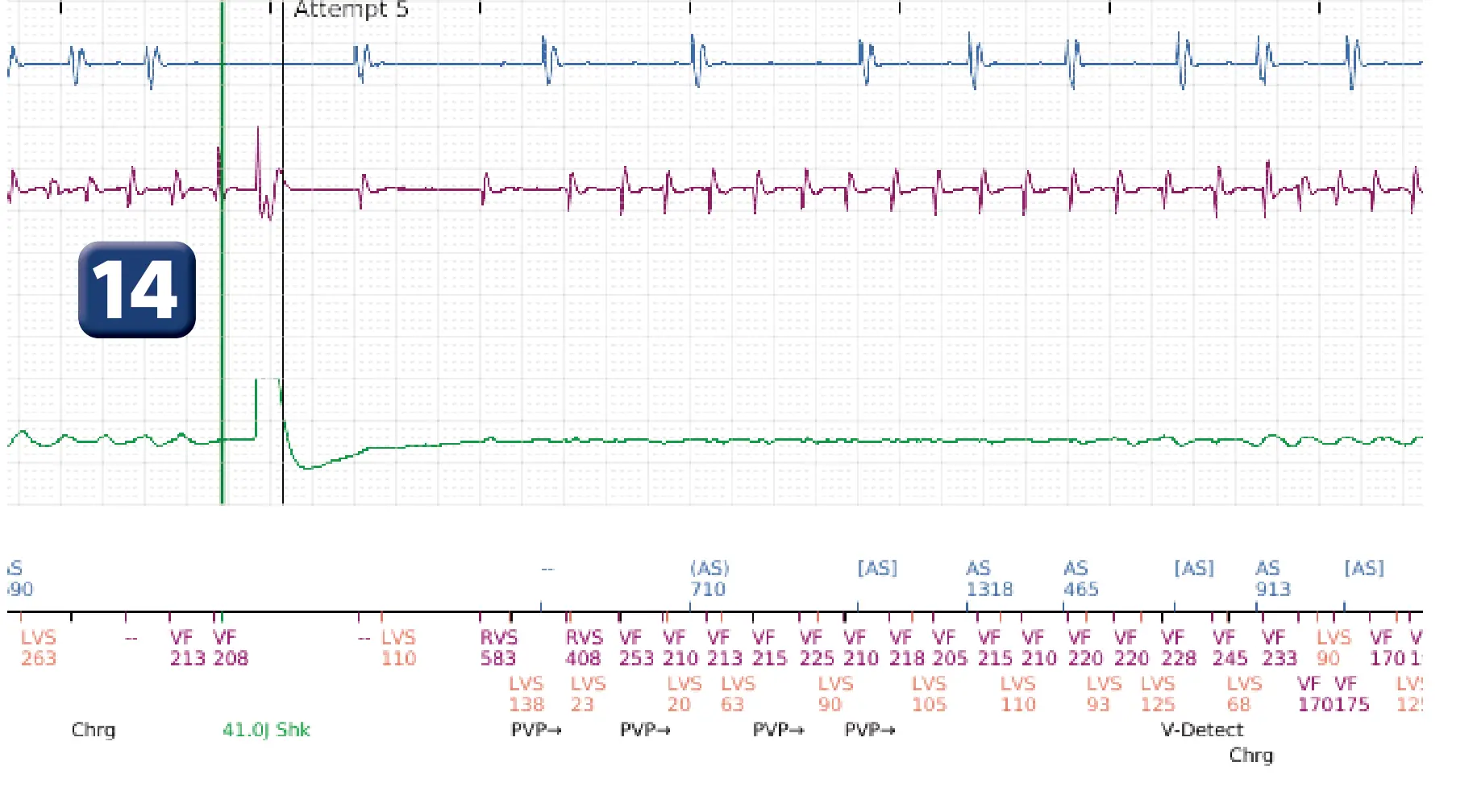 Boston Scientific ICD electrogram, segment 10 of 12 — Multiple electric shocks in the VF zone