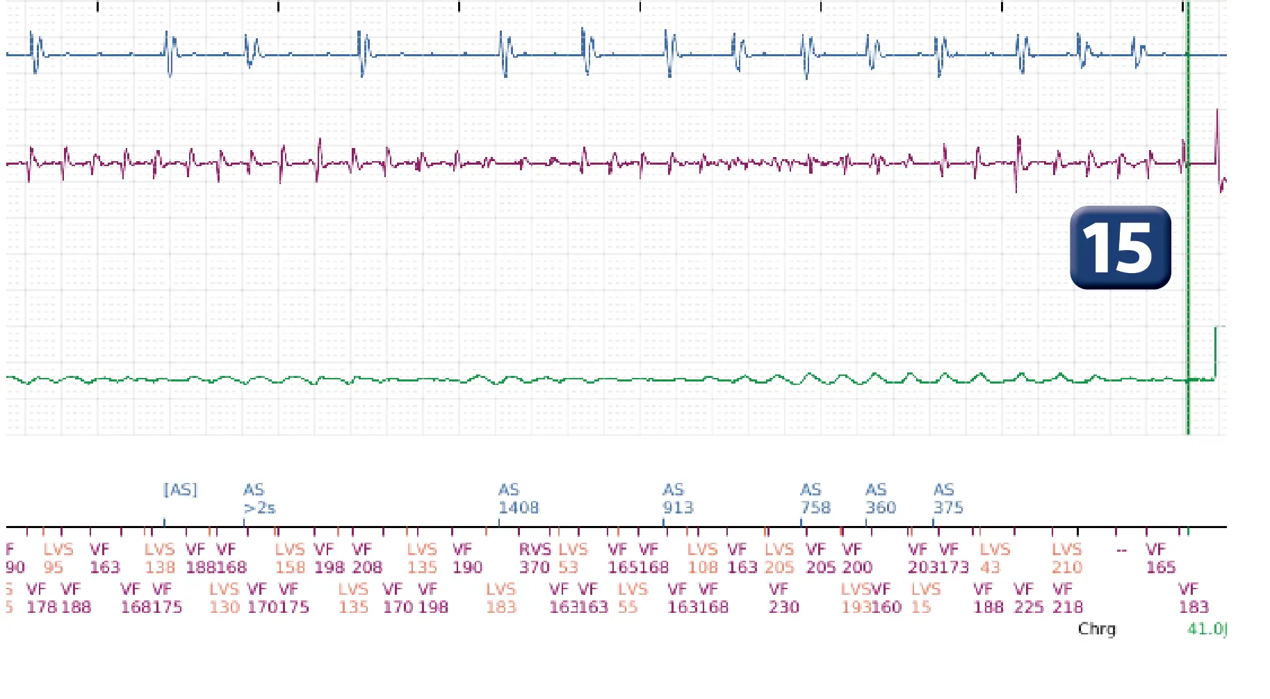 Boston Scientific ICD electrogram, segment 11 of 12 — Multiple electric shocks in the VF zone