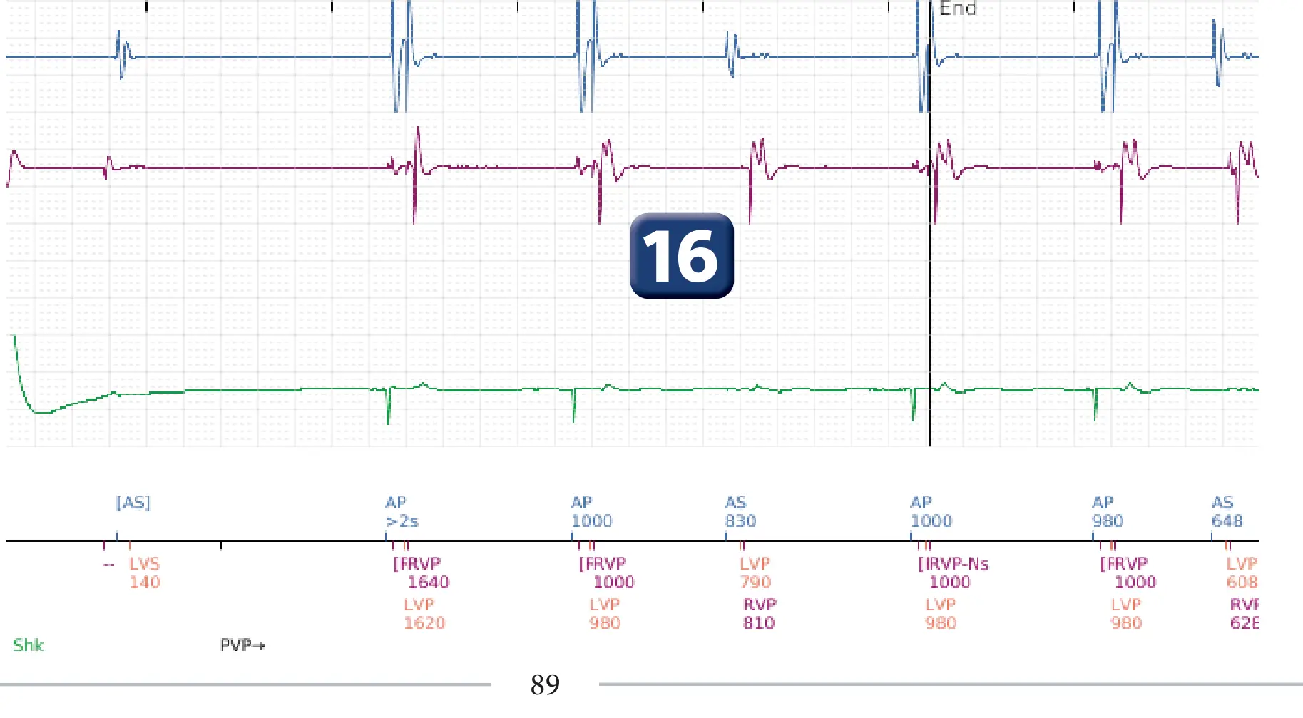 Boston Scientific ICD electrogram, segment 12 of 12 — Multiple electric shocks in the VF zone