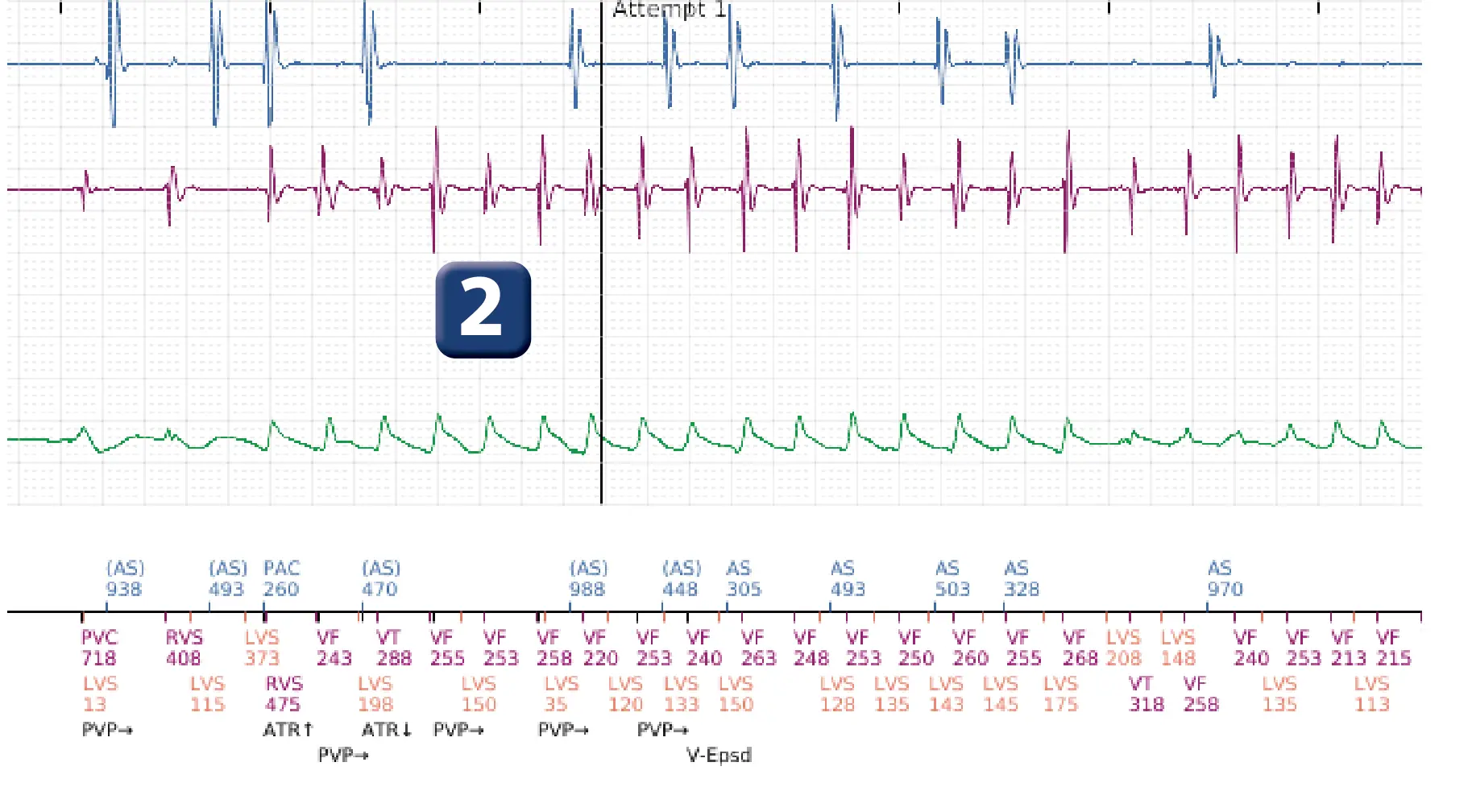 Boston Scientific ICD electrogram, segment 2 of 12 — Multiple electric shocks in the VF zone