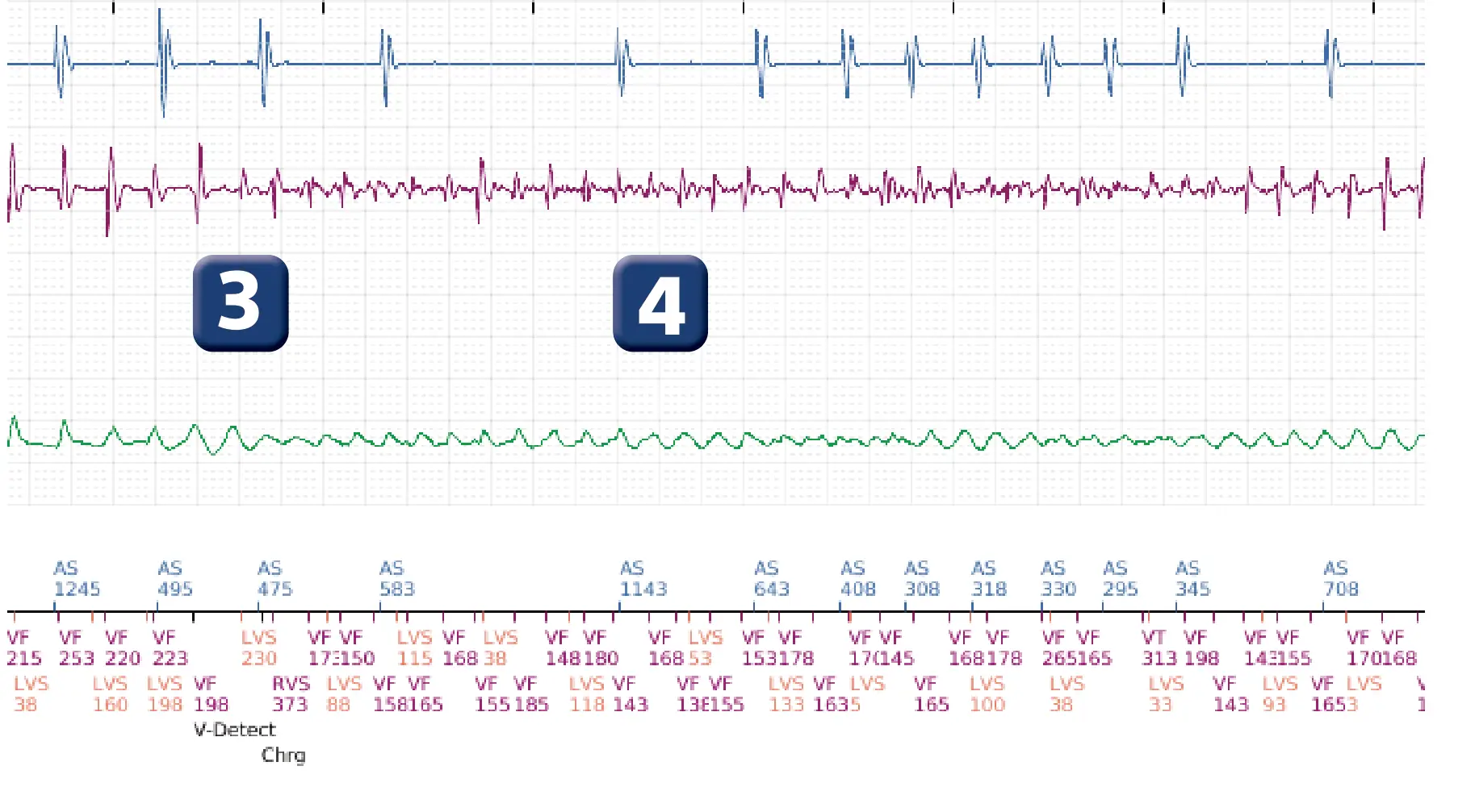 Boston Scientific ICD electrogram, segment 3 of 12 — Multiple electric shocks in the VF zone