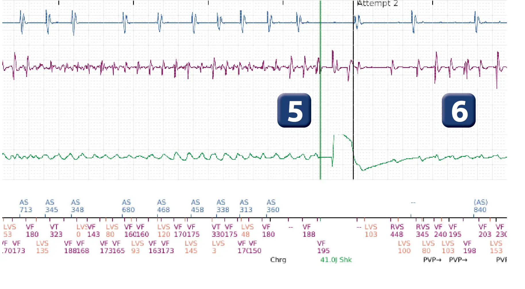 Boston Scientific ICD electrogram, segment 4 of 12 — Multiple electric shocks in the VF zone