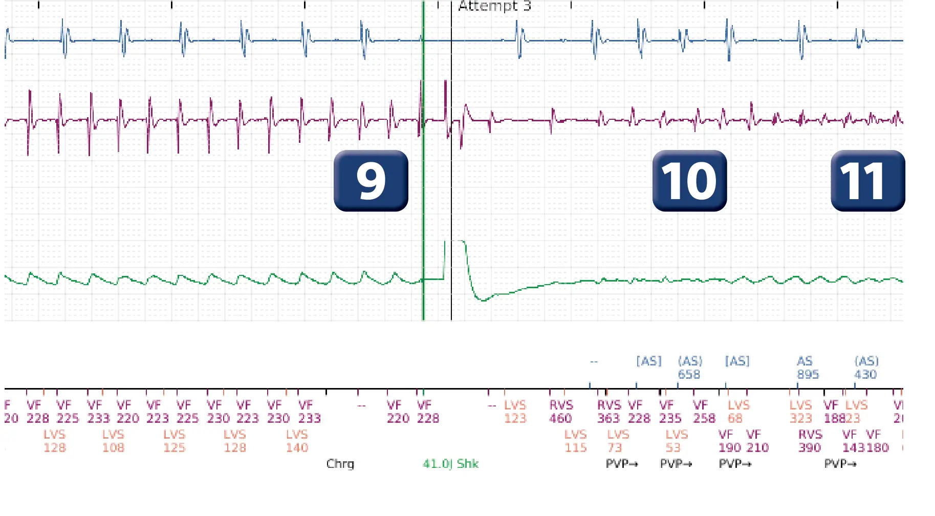 Boston Scientific ICD electrogram, segment 6 of 12 — Multiple electric shocks in the VF zone