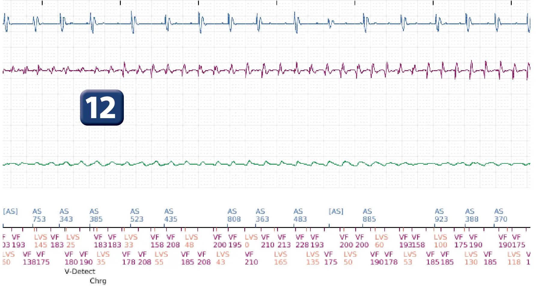 Boston Scientific ICD electrogram, segment 7 of 12 — Multiple electric shocks in the VF zone