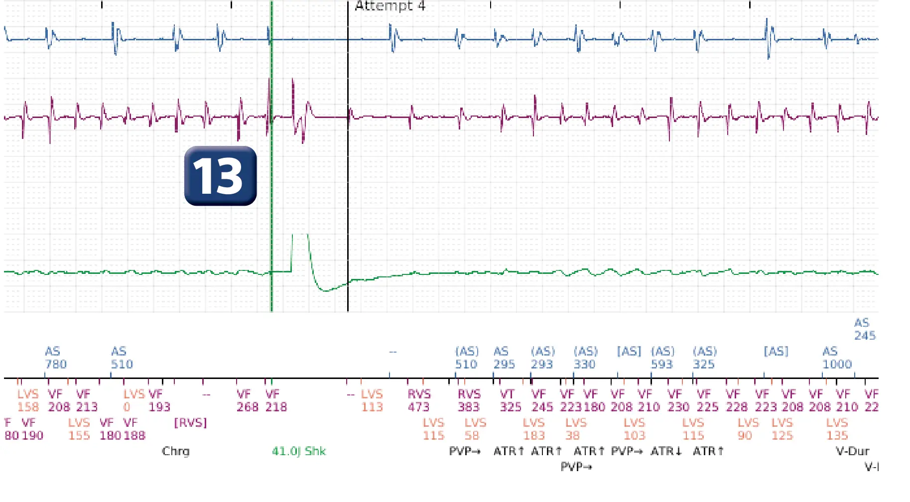 Boston Scientific ICD electrogram, segment 8 of 12 — Multiple electric shocks in the VF zone