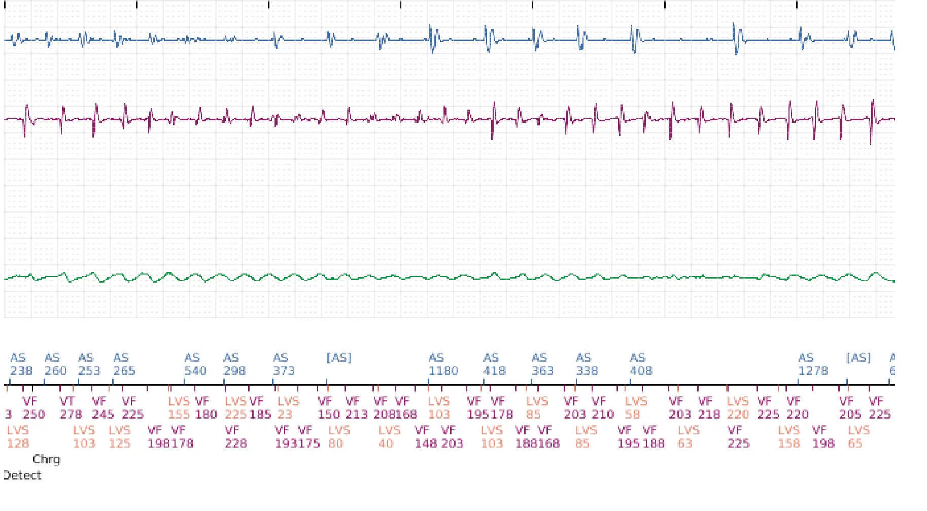 Boston Scientific ICD electrogram, segment 9 of 12 — Multiple electric shocks in the VF zone
