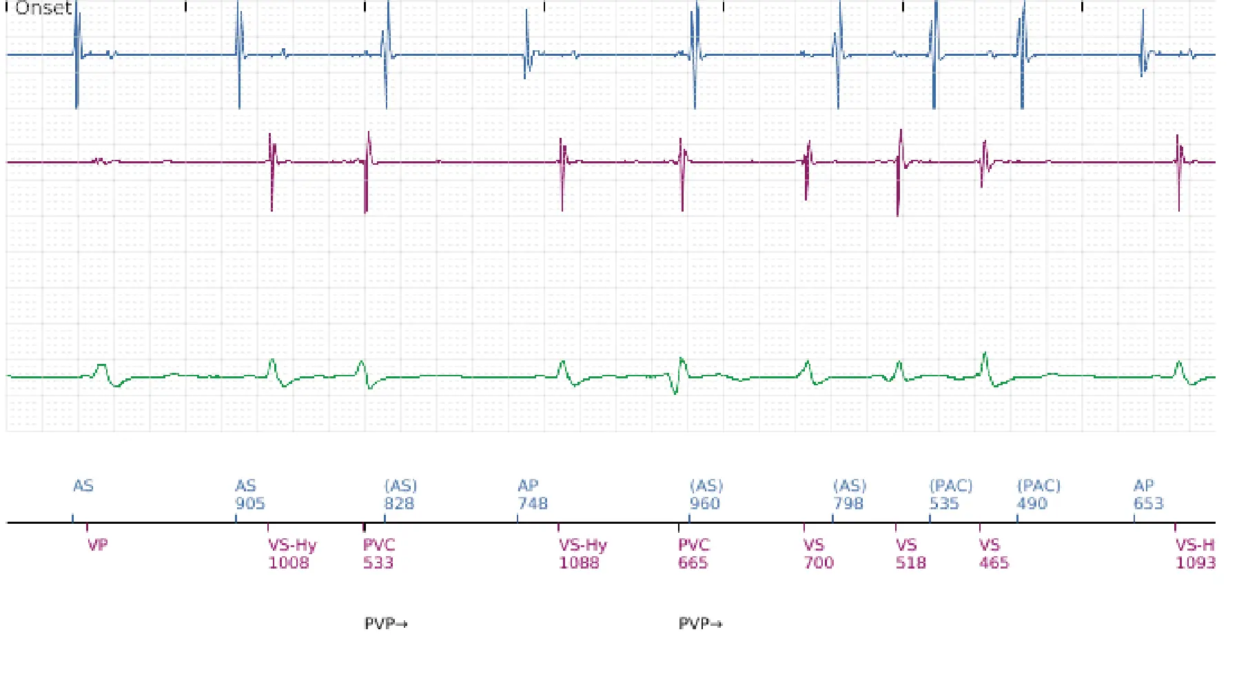 Boston Scientific ICD electrogram, segment 1 of 14 — VT in the VF zone and high defibrillation threshold