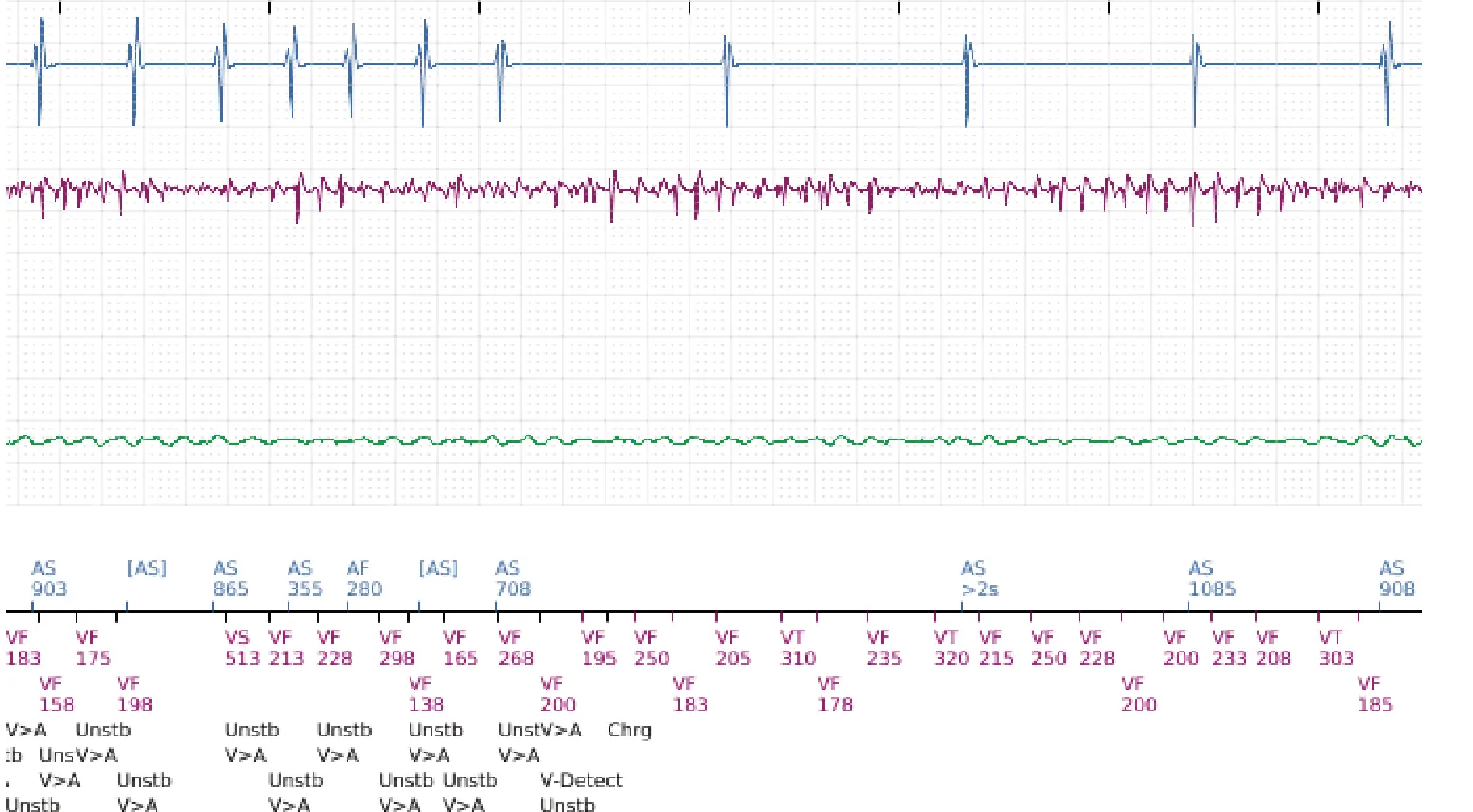 Boston Scientific ICD electrogram, segment 10 of 14 — VT in the VF zone and high defibrillation threshold