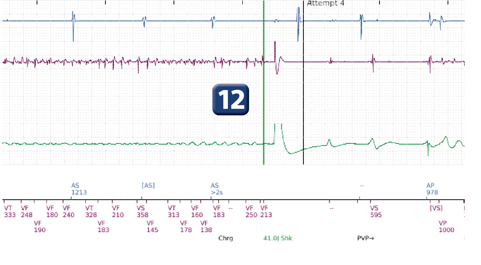 Boston Scientific ICD electrogram, segment 11 of 14 — VT in the VF zone and high defibrillation threshold