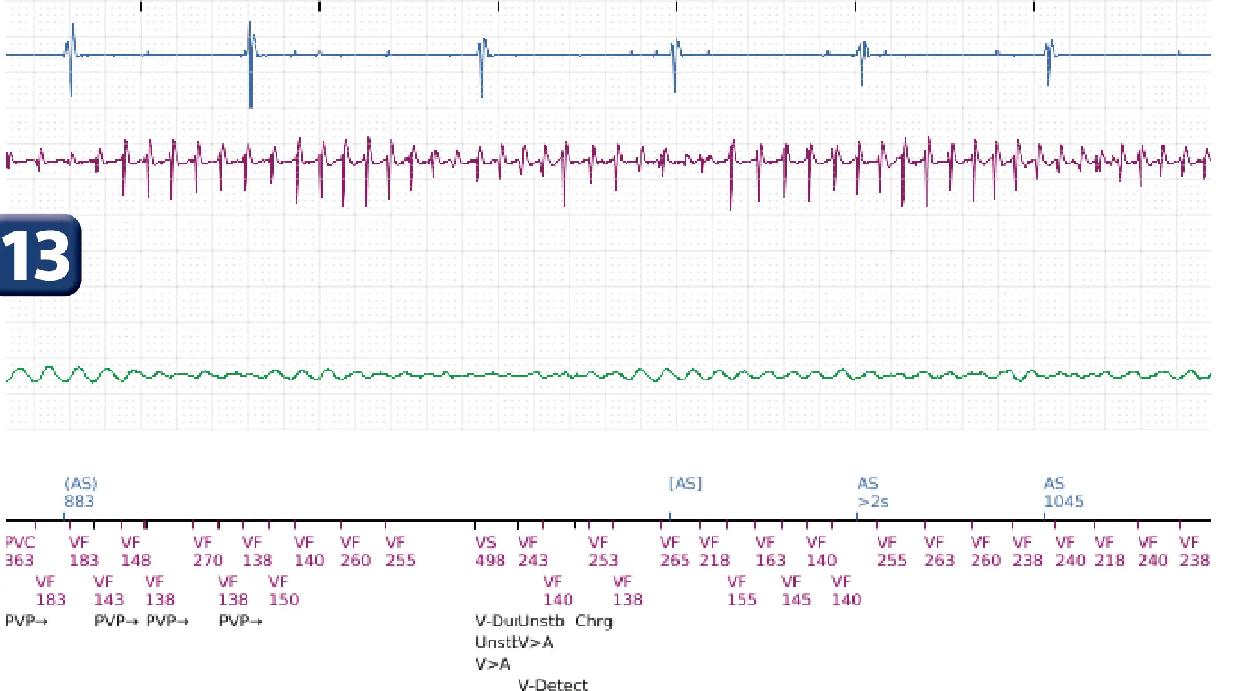 Boston Scientific ICD electrogram, segment 12 of 14 — VT in the VF zone and high defibrillation threshold
