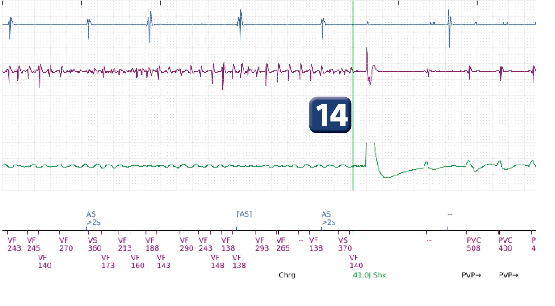 Boston Scientific ICD electrogram, segment 13 of 14 — VT in the VF zone and high defibrillation threshold