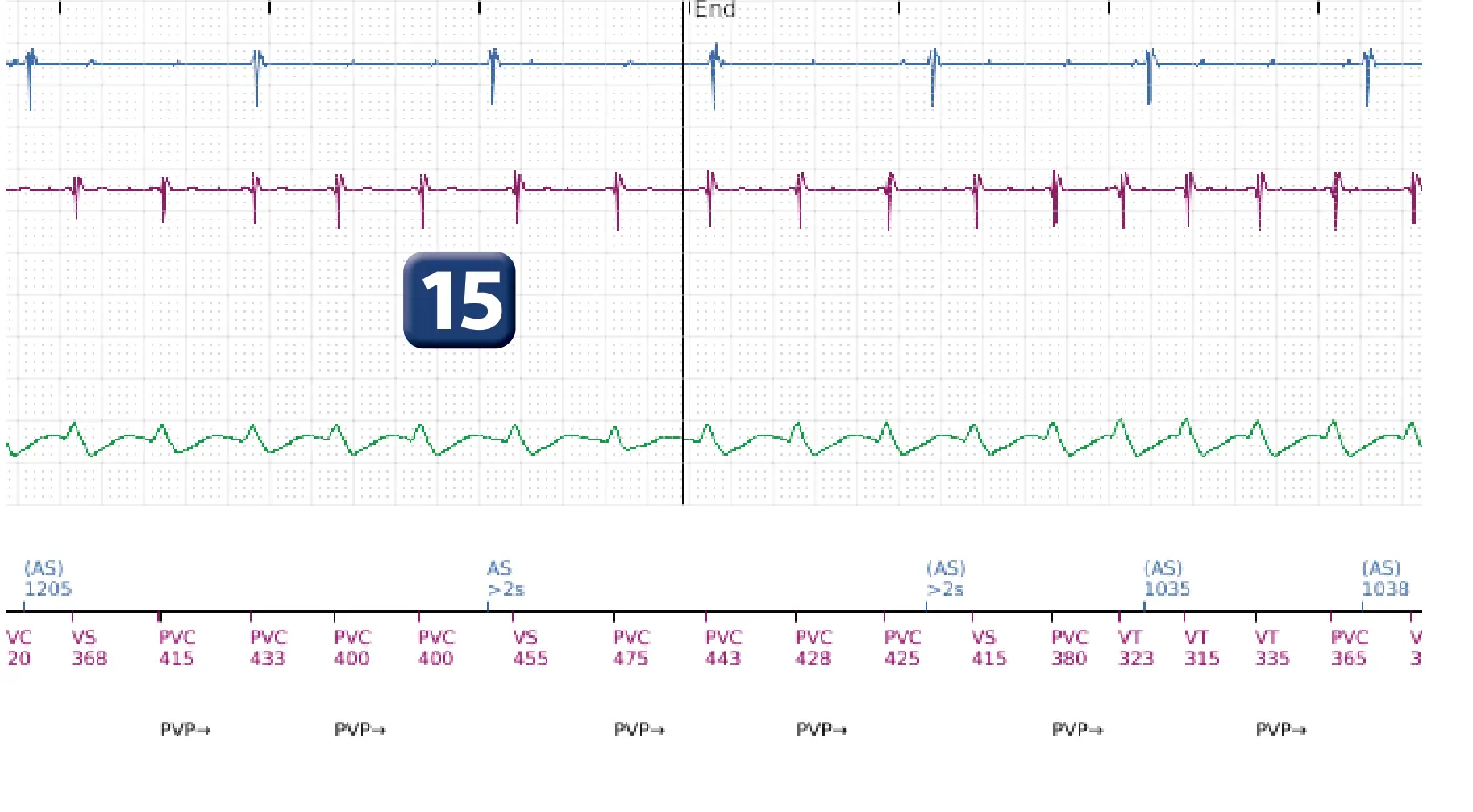 Boston Scientific ICD electrogram, segment 14 of 14 — VT in the VF zone and high defibrillation threshold