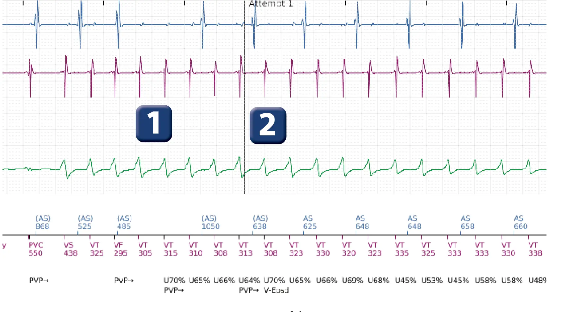 Boston Scientific ICD electrogram, segment 2 of 14 — VT in the VF zone and high defibrillation threshold