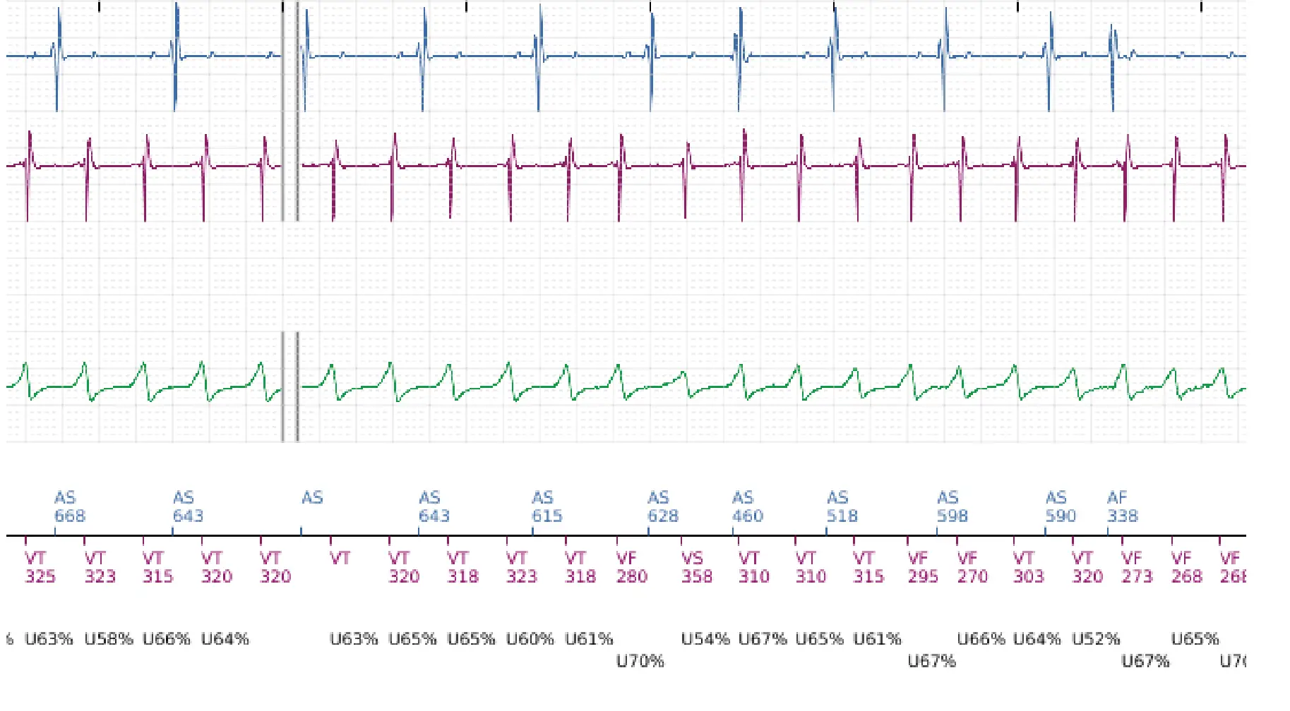 Boston Scientific ICD electrogram, segment 3 of 14 — VT in the VF zone and high defibrillation threshold