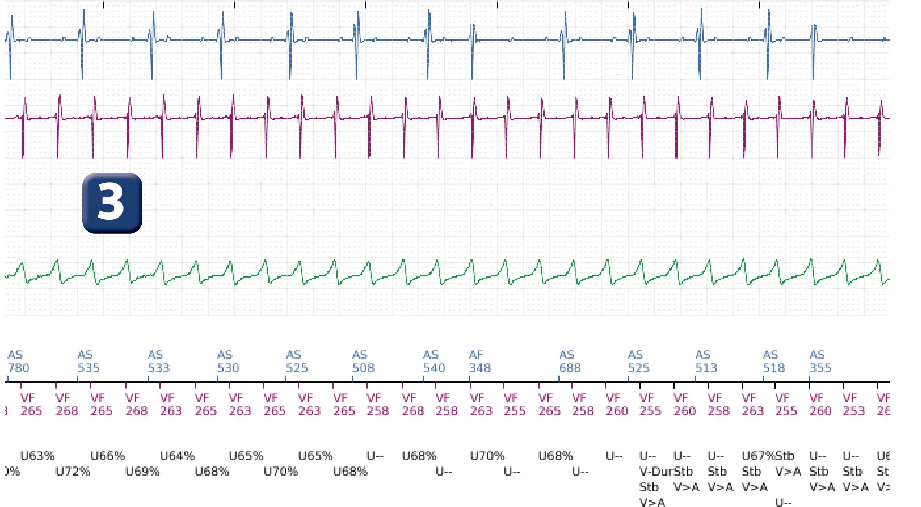 Boston Scientific ICD electrogram, segment 4 of 14 — VT in the VF zone and high defibrillation threshold