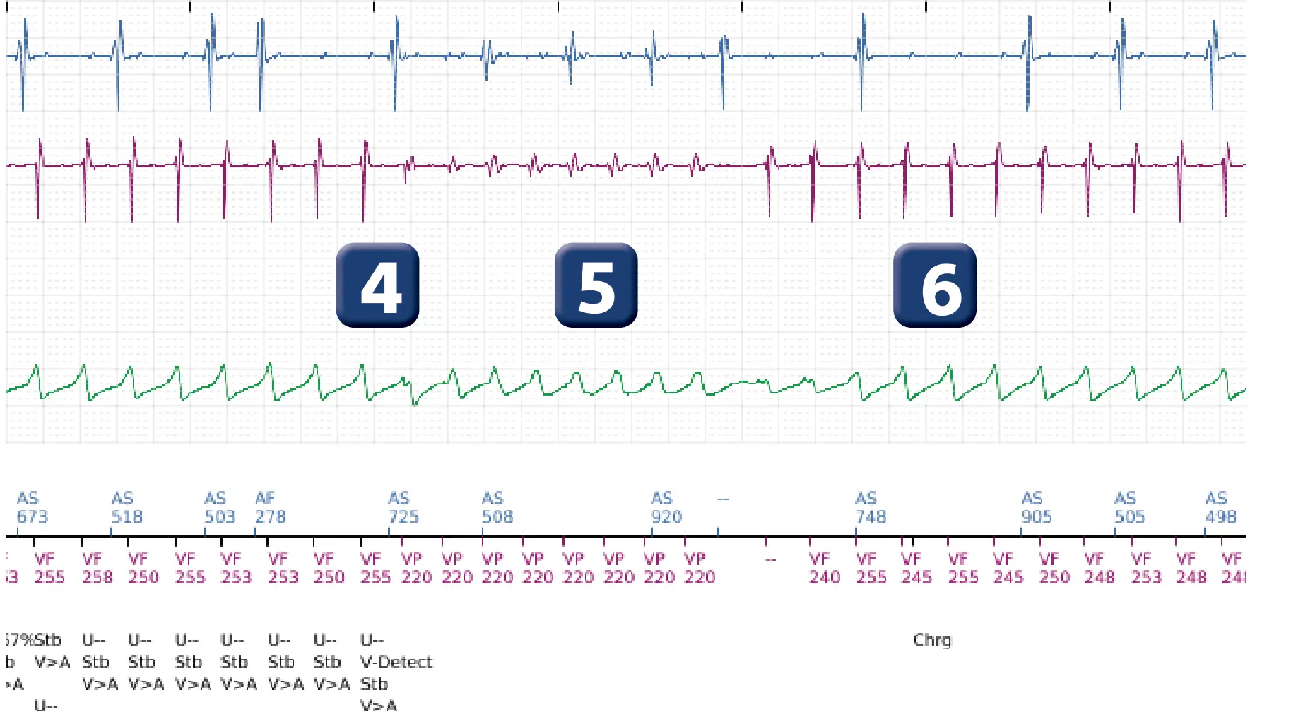 Boston Scientific ICD electrogram, segment 5 of 14 — VT in the VF zone and high defibrillation threshold