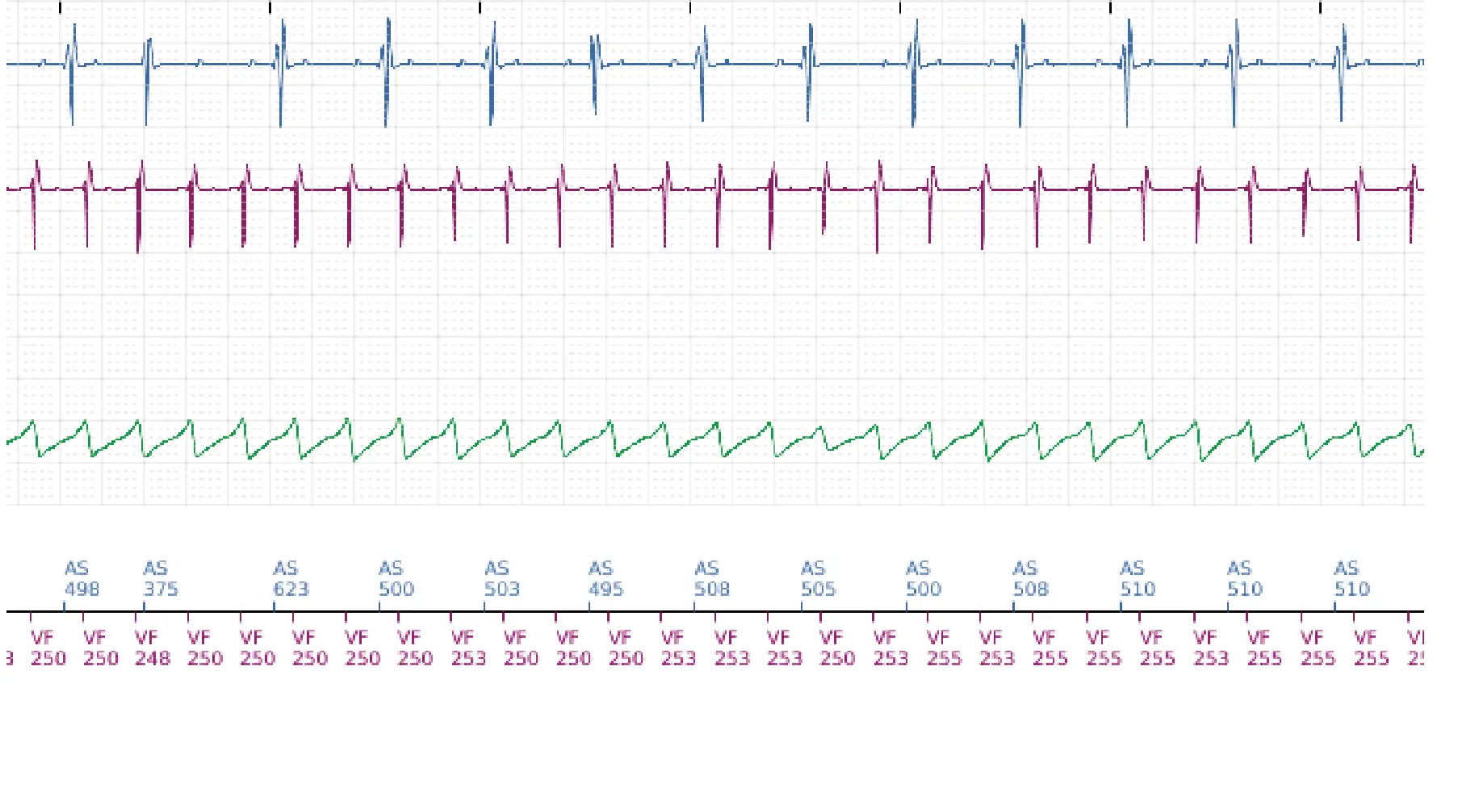 Boston Scientific ICD electrogram, segment 6 of 14 — VT in the VF zone and high defibrillation threshold