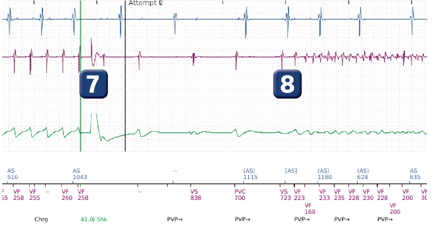 Boston Scientific ICD electrogram, segment 7 of 14 — VT in the VF zone and high defibrillation threshold