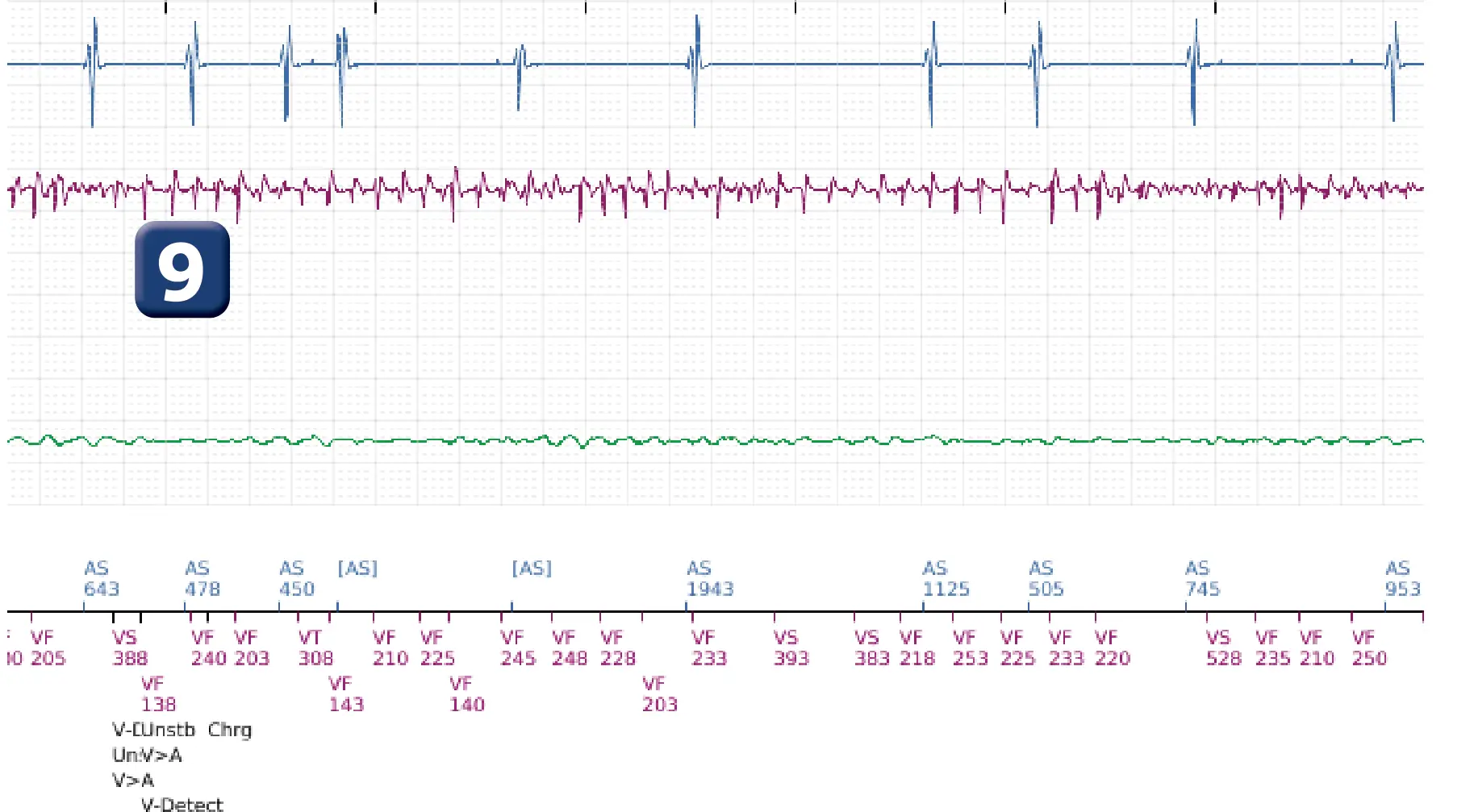 Boston Scientific ICD electrogram, segment 8 of 14 — VT in the VF zone and high defibrillation threshold