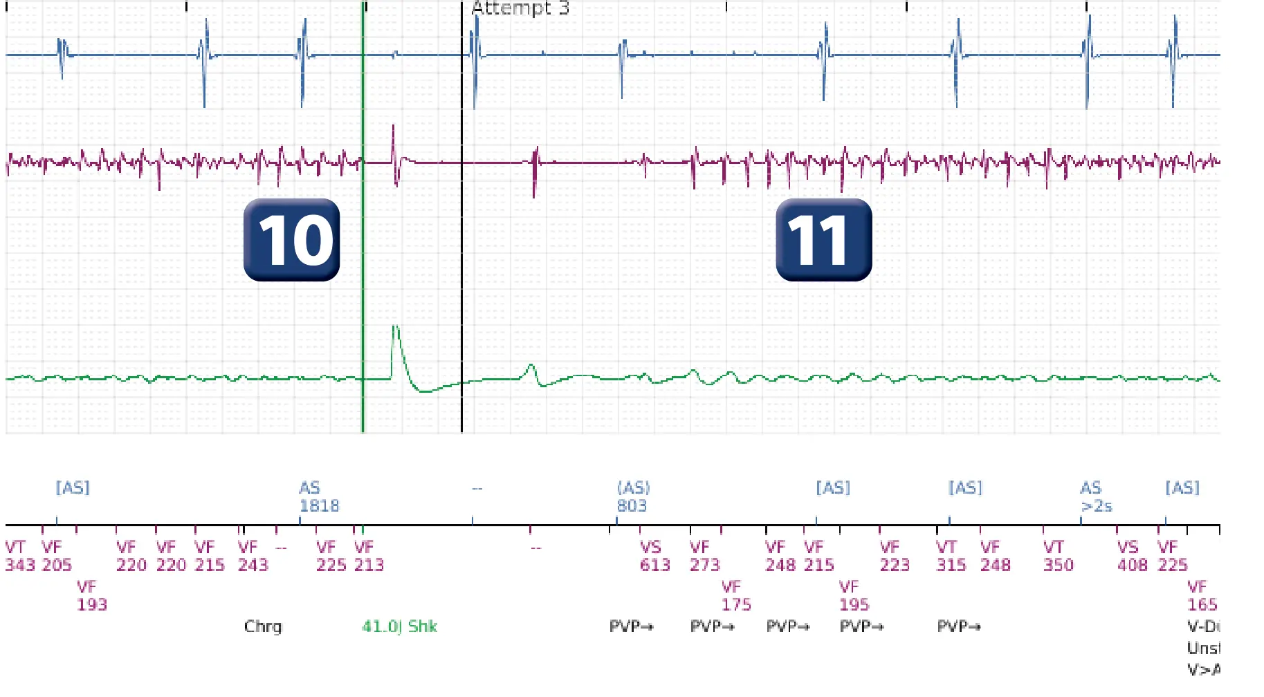 Boston Scientific ICD electrogram, segment 9 of 14 — VT in the VF zone and high defibrillation threshold