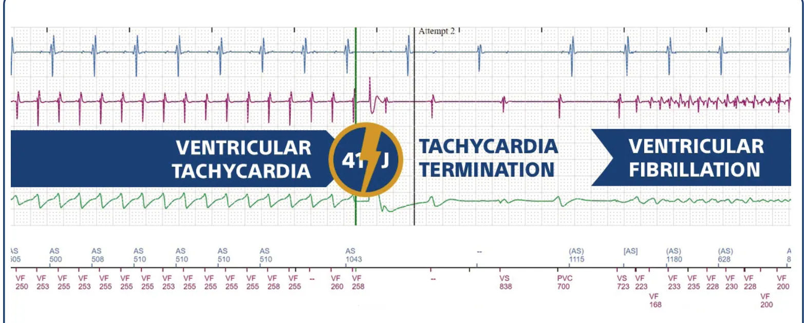 The tracing shows how the shock delivered during a monomorphic tachycardia (VT) interrupts the tachycardia with immediate reinduction of a polymorphic, disorganized, low-voltage arrhythmia (VF).