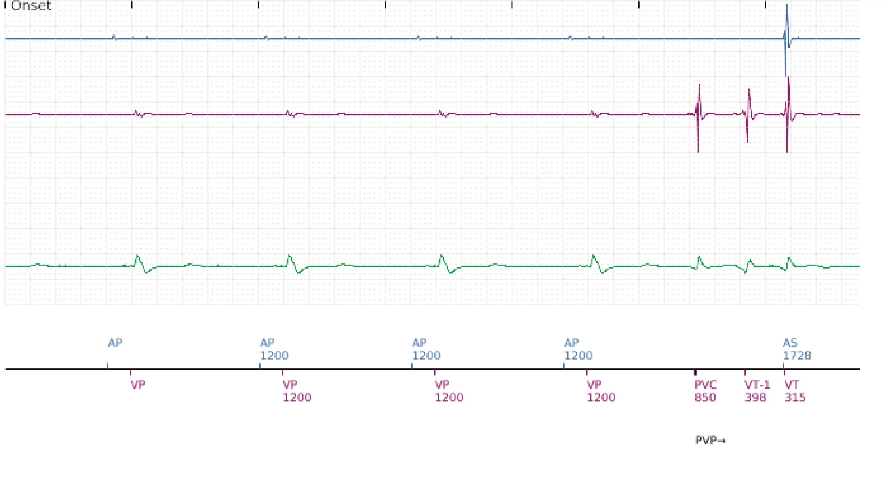 Boston Scientific ICD electrogram, segment 1 of 7 — VF, device shock with AF induction