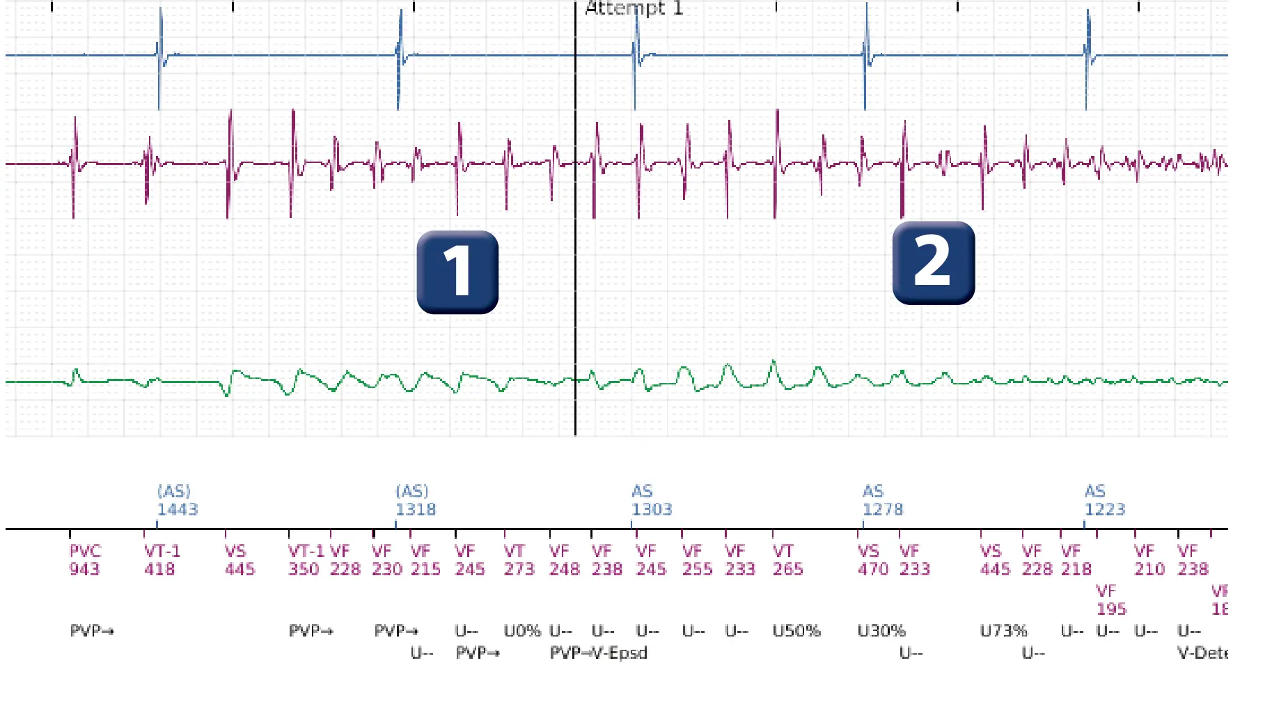 Boston Scientific ICD electrogram, segment 2 of 7 — VF, device shock with AF induction
