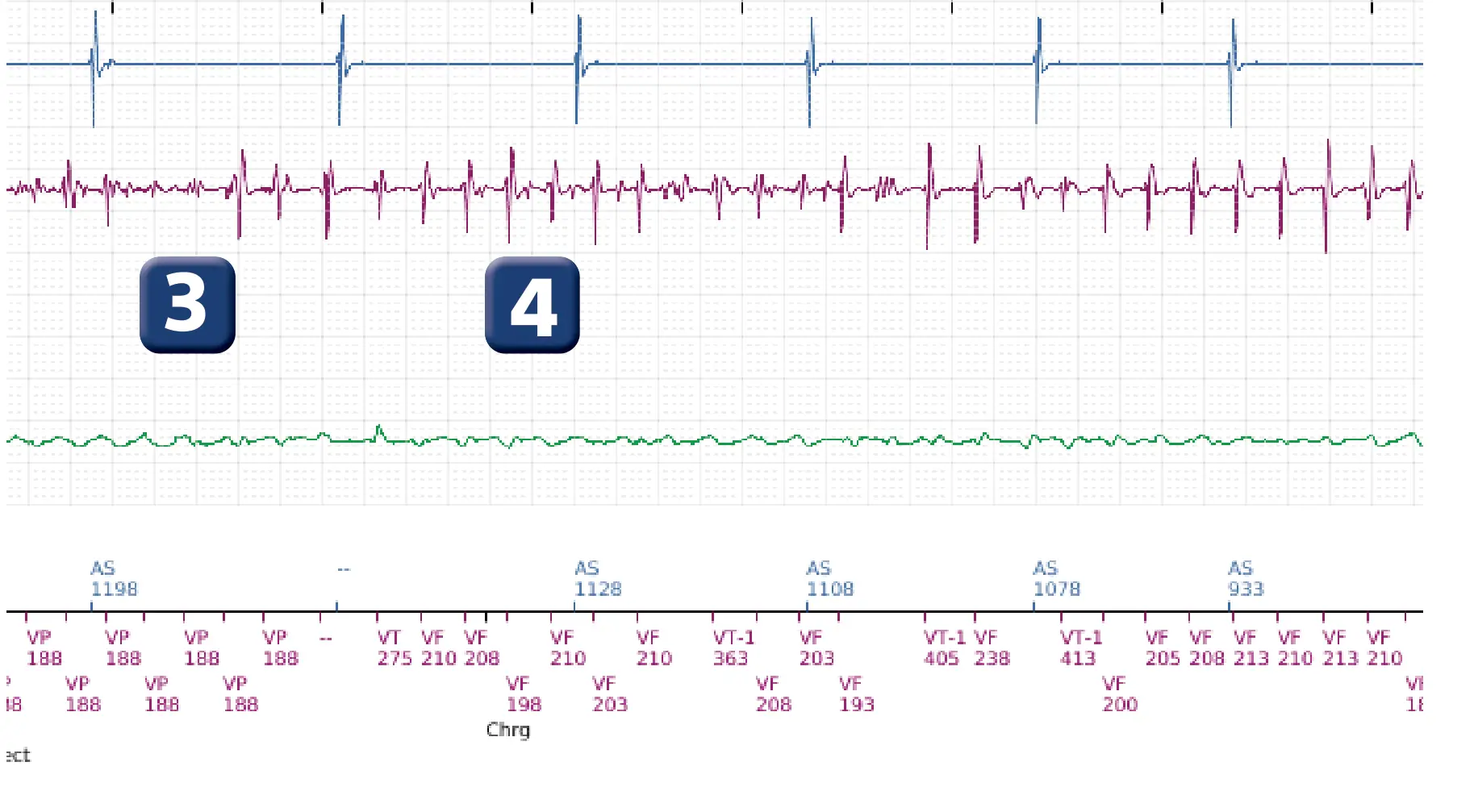 Boston Scientific ICD electrogram, segment 3 of 7 — VF, device shock with AF induction