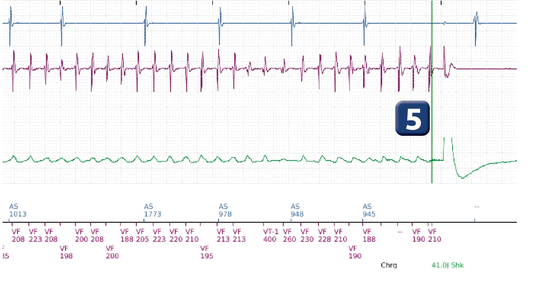 Boston Scientific ICD electrogram, segment 4 of 7 — VF, device shock with AF induction