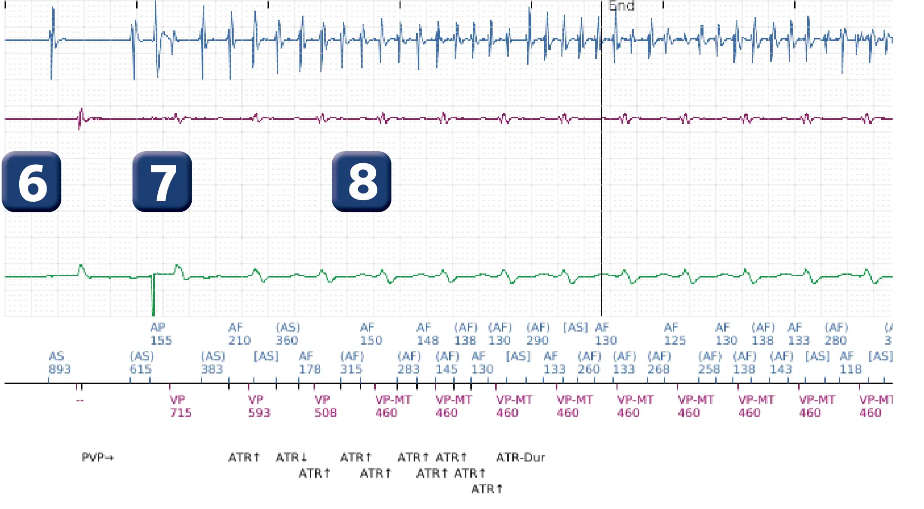 Boston Scientific ICD electrogram, segment 5 of 7 — VF, device shock with AF induction