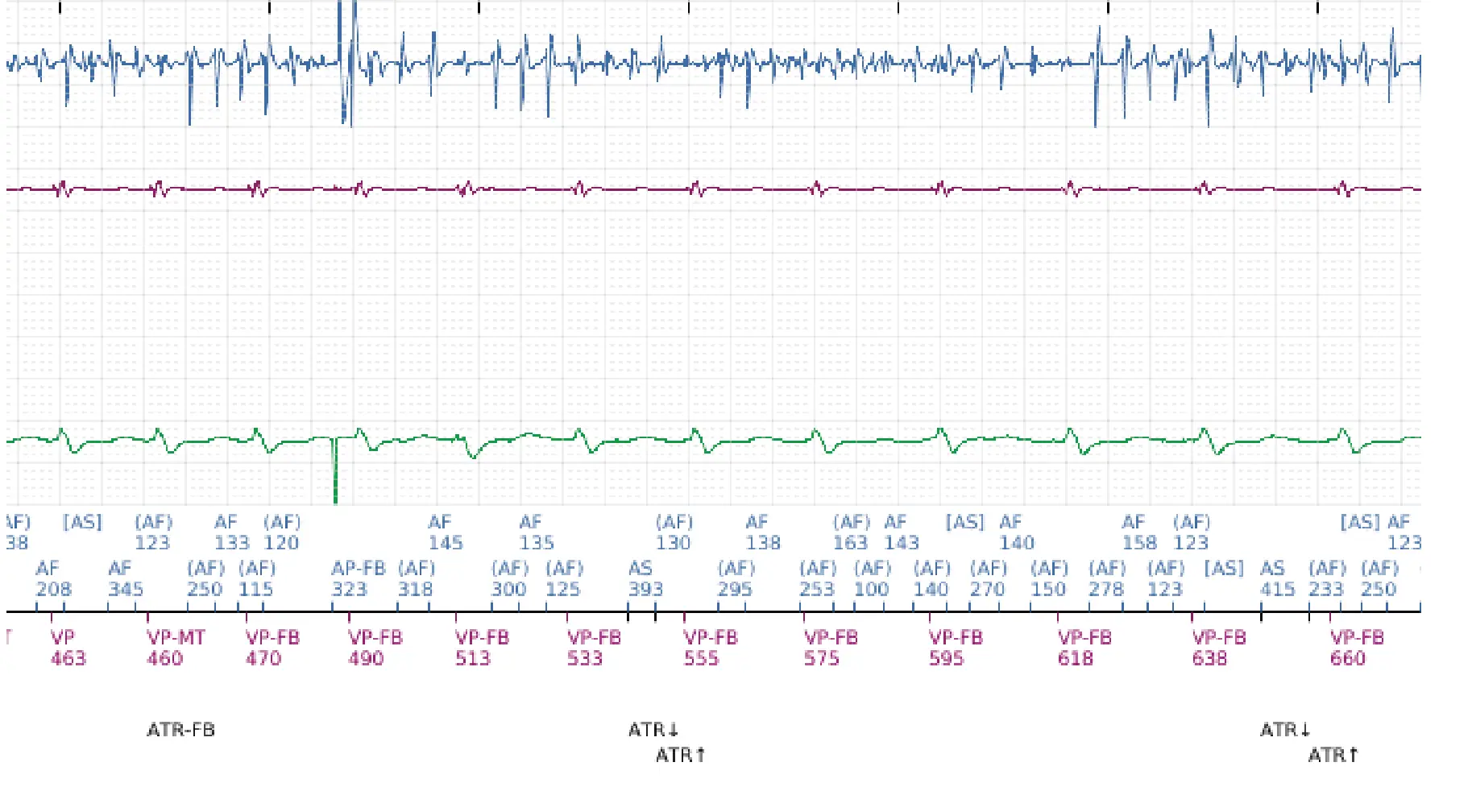 Boston Scientific ICD electrogram, segment 6 of 7 — VF, device shock with AF induction