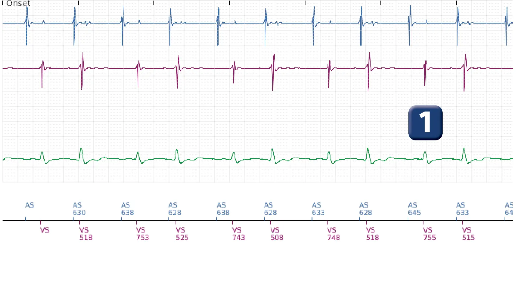 Boston Scientific ICD electrogram, segment 1 of 12 — ATP burst in the VF zone