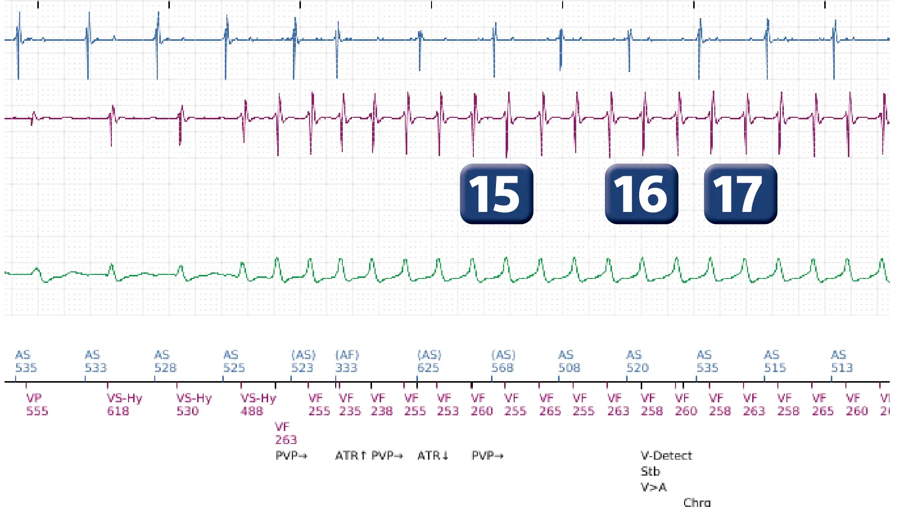 Boston Scientific ICD electrogram, segment 10 of 12 — ATP burst in the VF zone