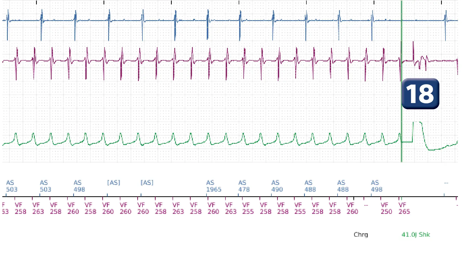 Boston Scientific ICD electrogram, segment 11 of 12 — ATP burst in the VF zone