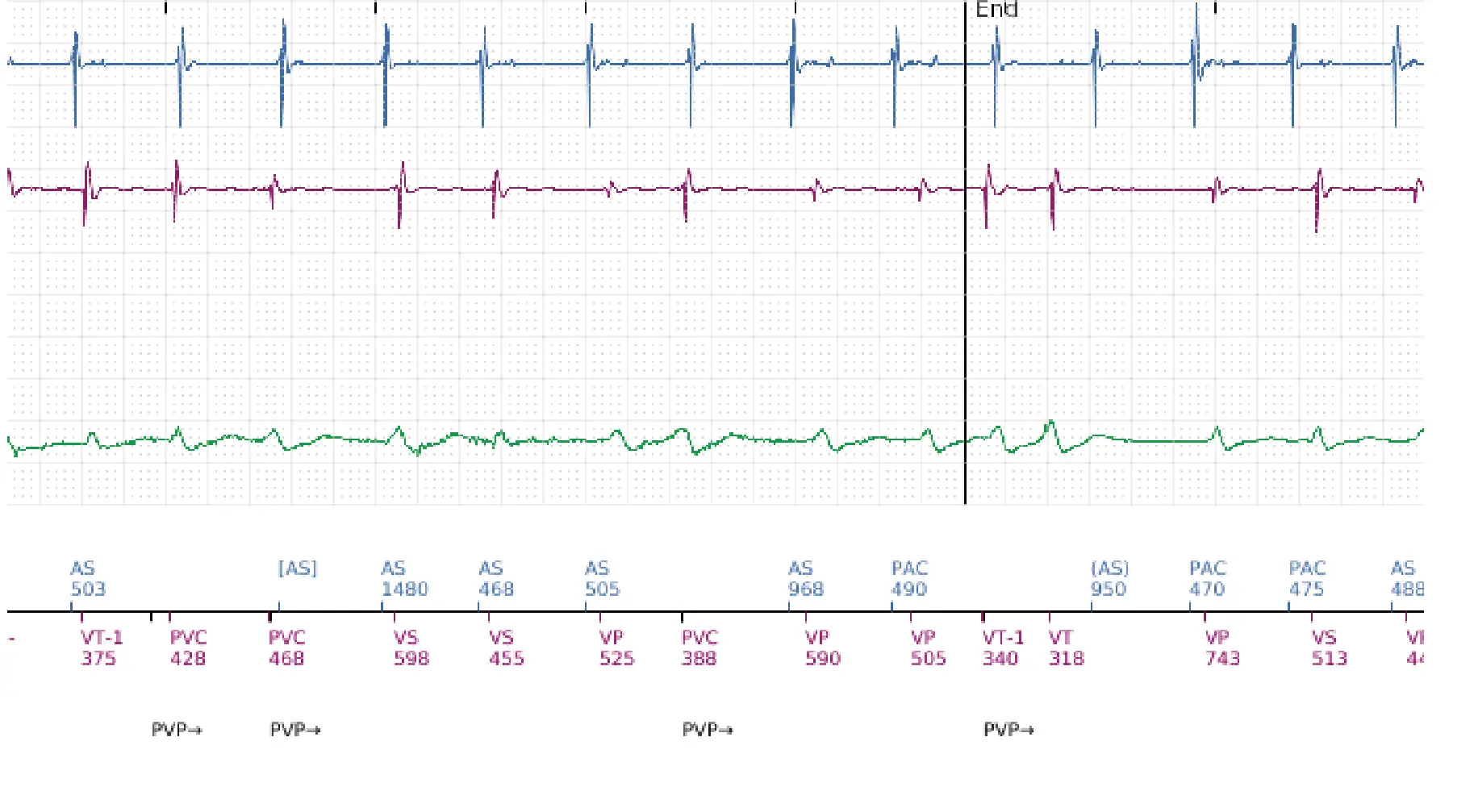 Boston Scientific ICD electrogram, segment 12 of 12 — ATP burst in the VF zone