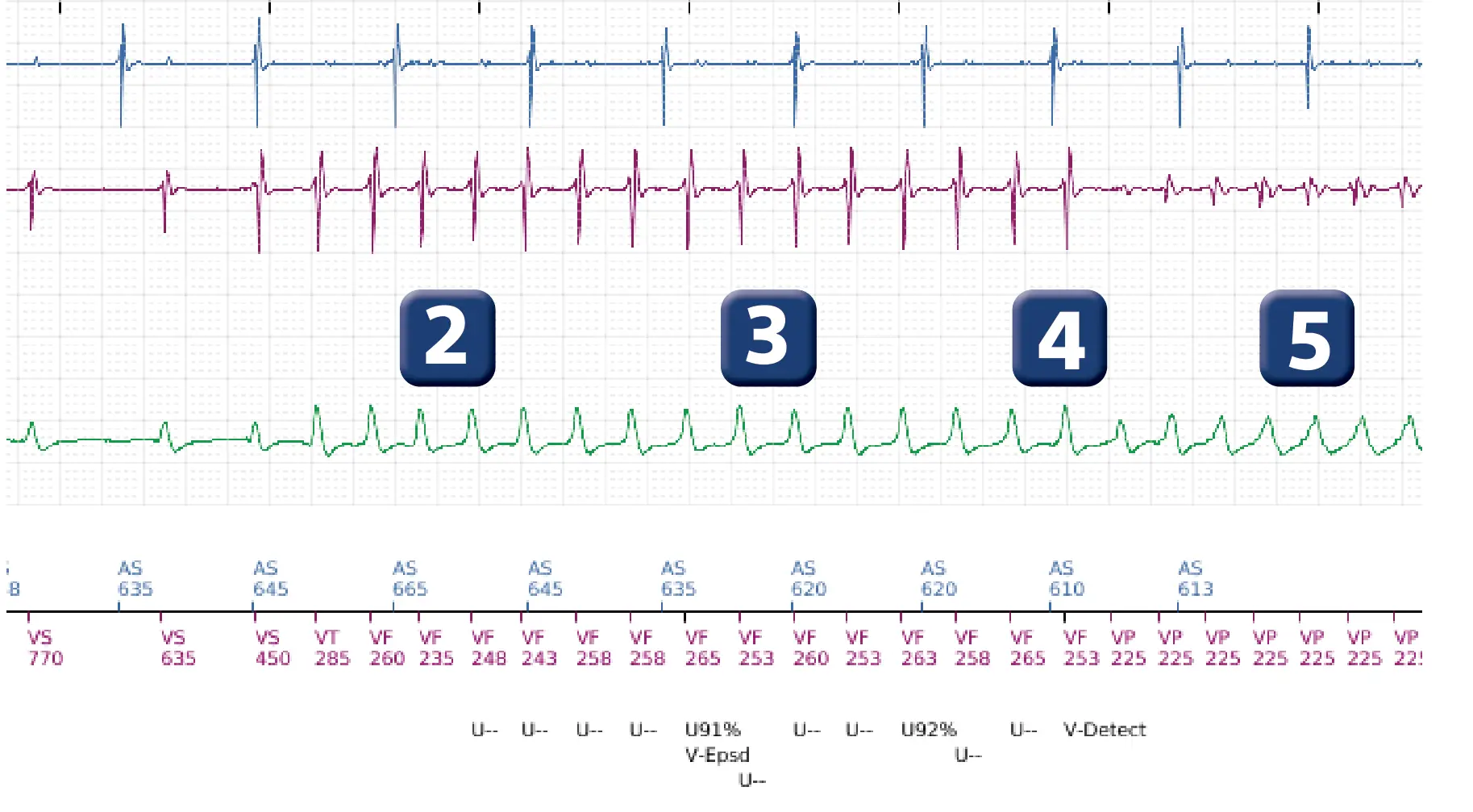 Boston Scientific ICD electrogram, segment 2 of 12 — ATP burst in the VF zone