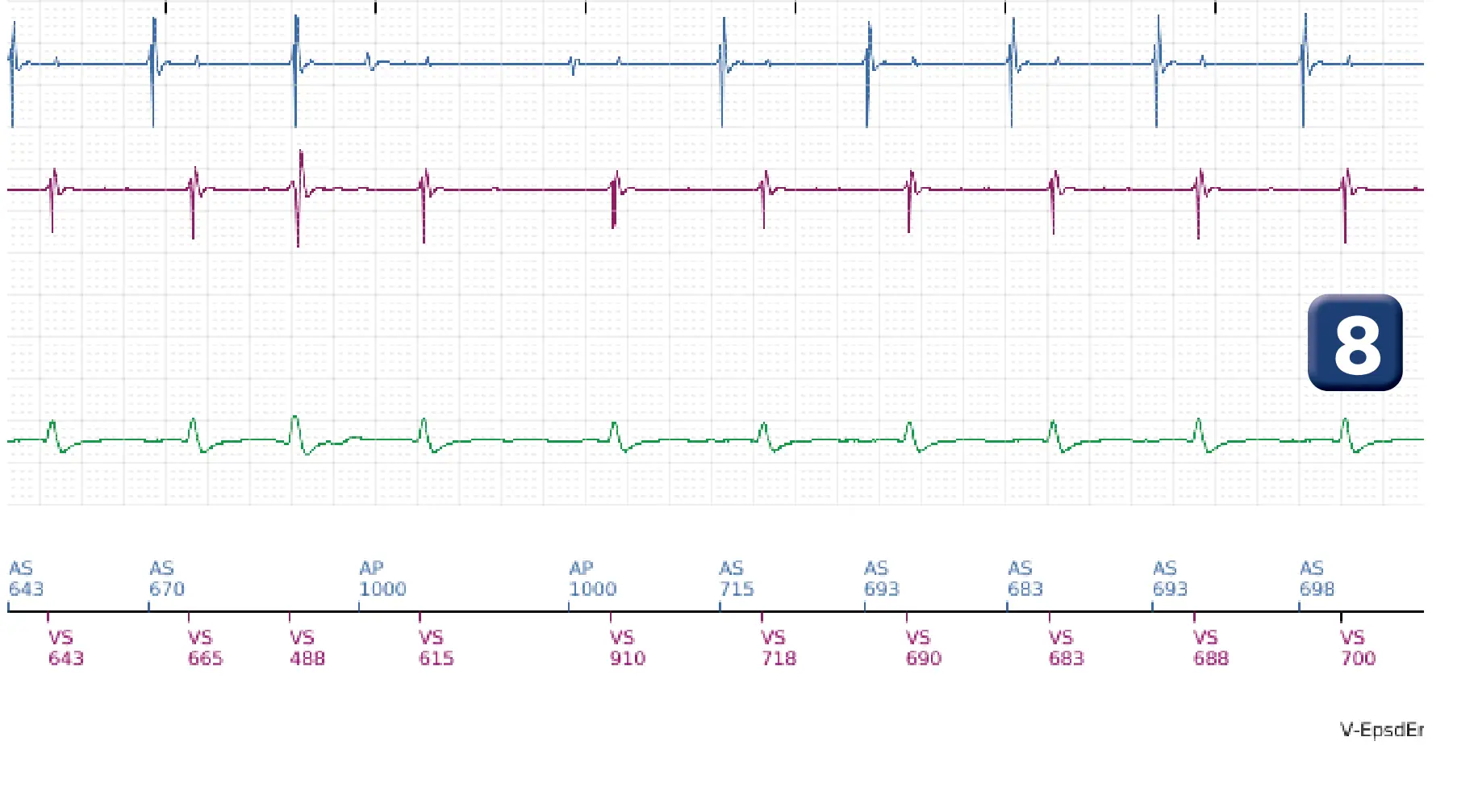 Boston Scientific ICD electrogram, segment 4 of 12 — ATP burst in the VF zone