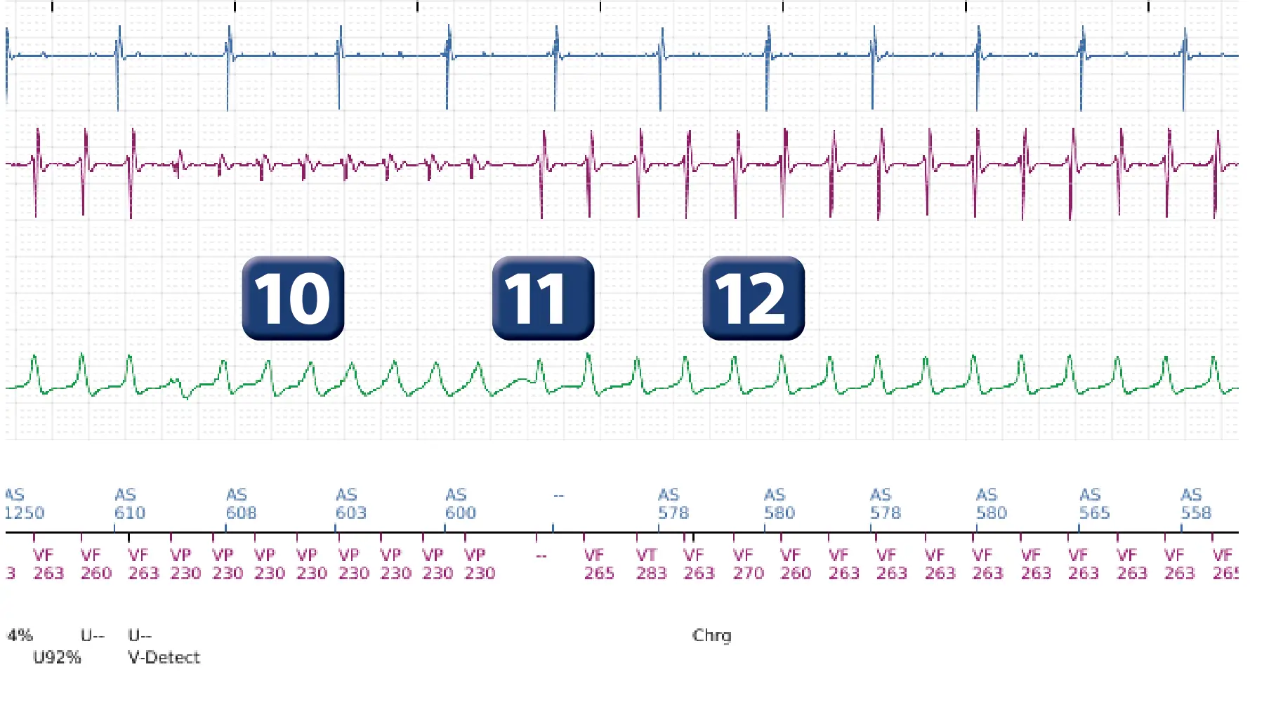 Boston Scientific ICD electrogram, segment 6 of 12 — ATP burst in the VF zone
