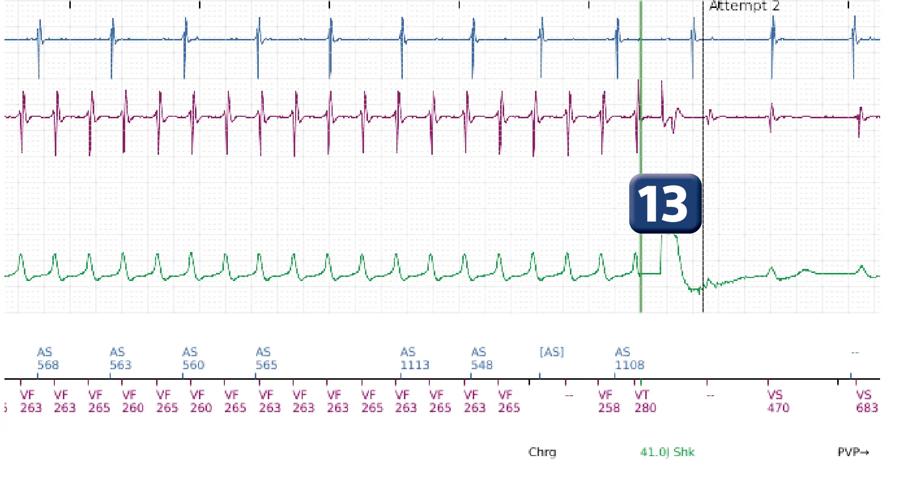 Boston Scientific ICD electrogram, segment 7 of 12 — ATP burst in the VF zone