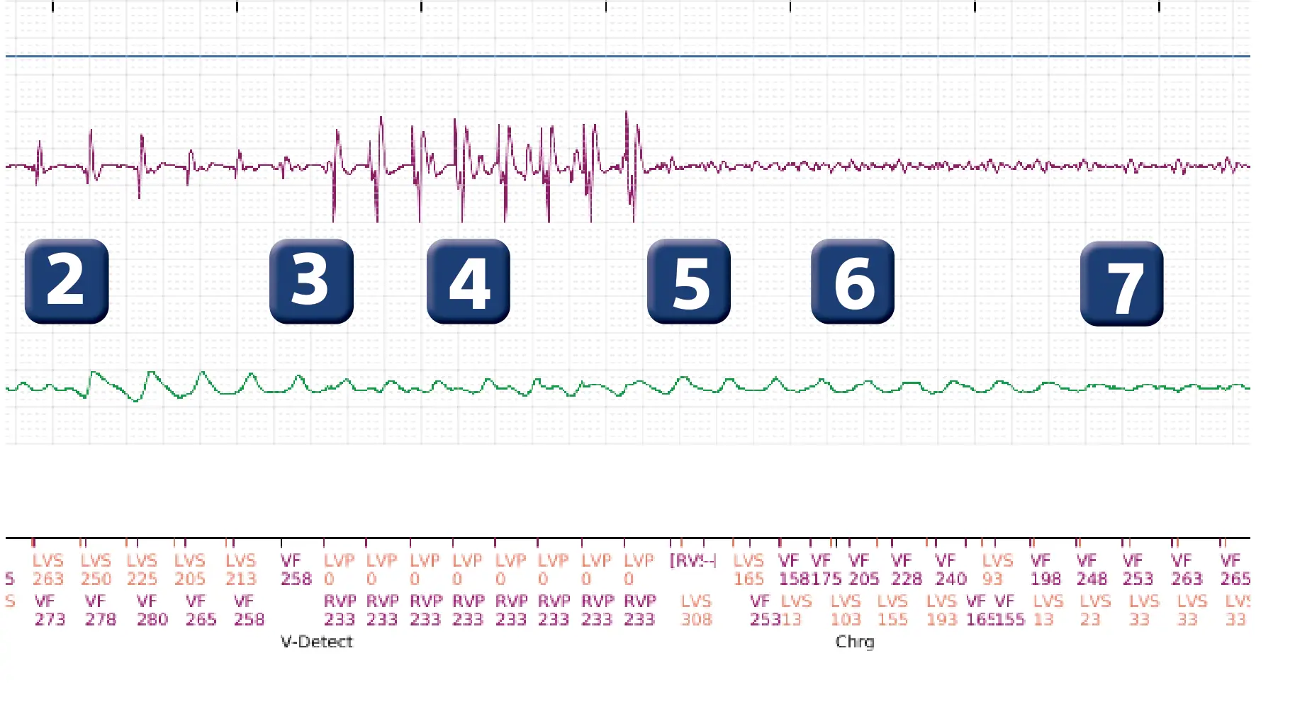 Boston Scientific ICD electrogram, segment 2 of 4 — ATP burst in the VF zone with acceleration