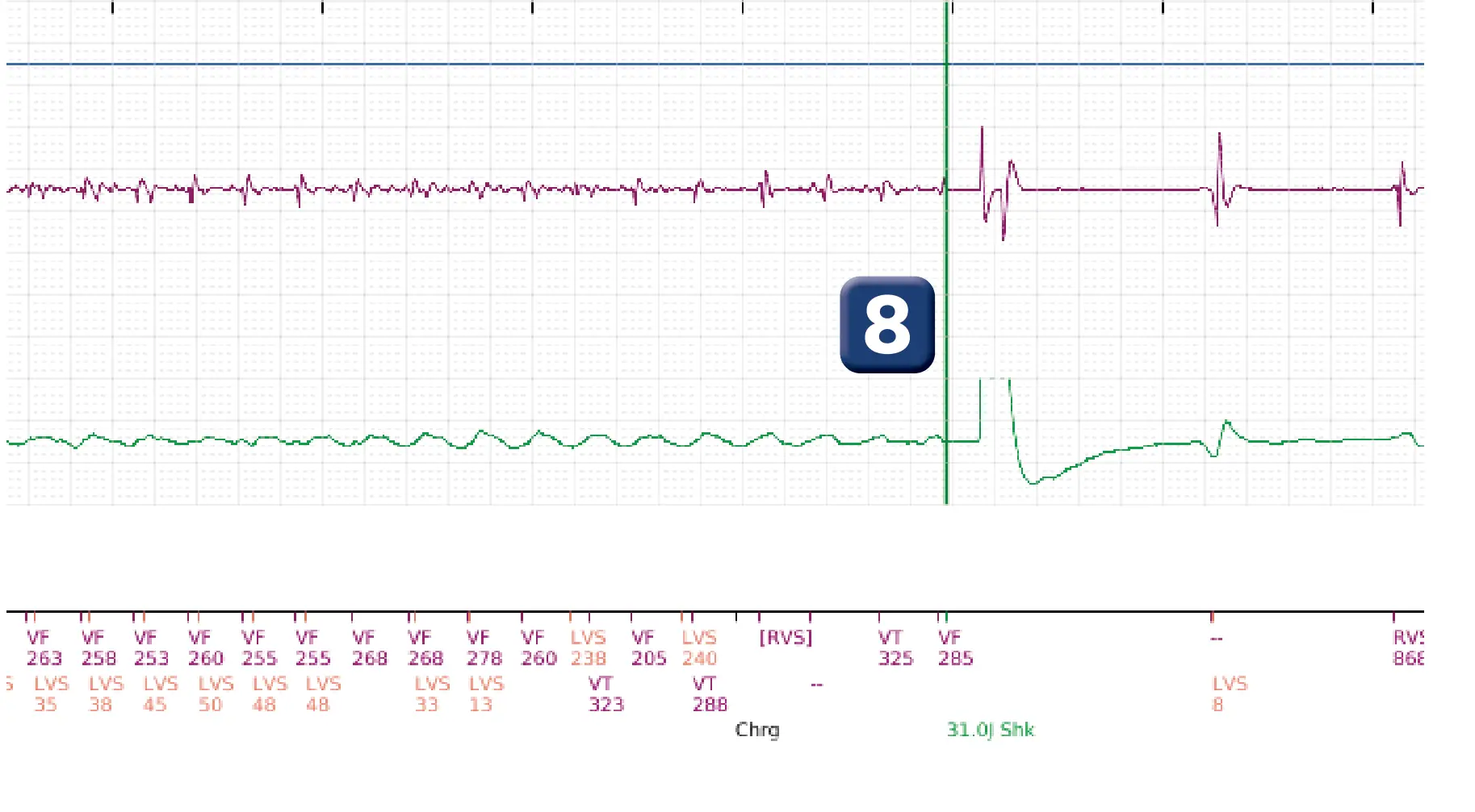 Boston Scientific ICD electrogram, segment 3 of 4 — ATP burst in the VF zone with acceleration