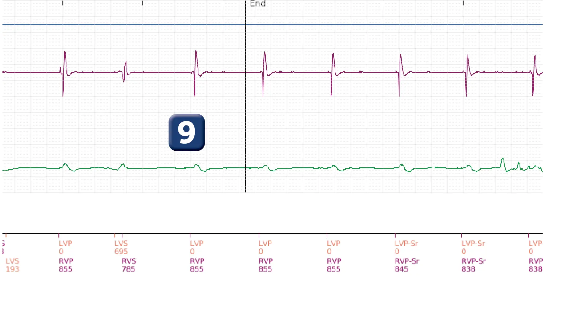 Boston Scientific ICD electrogram, segment 4 of 4 — ATP burst in the VF zone with acceleration