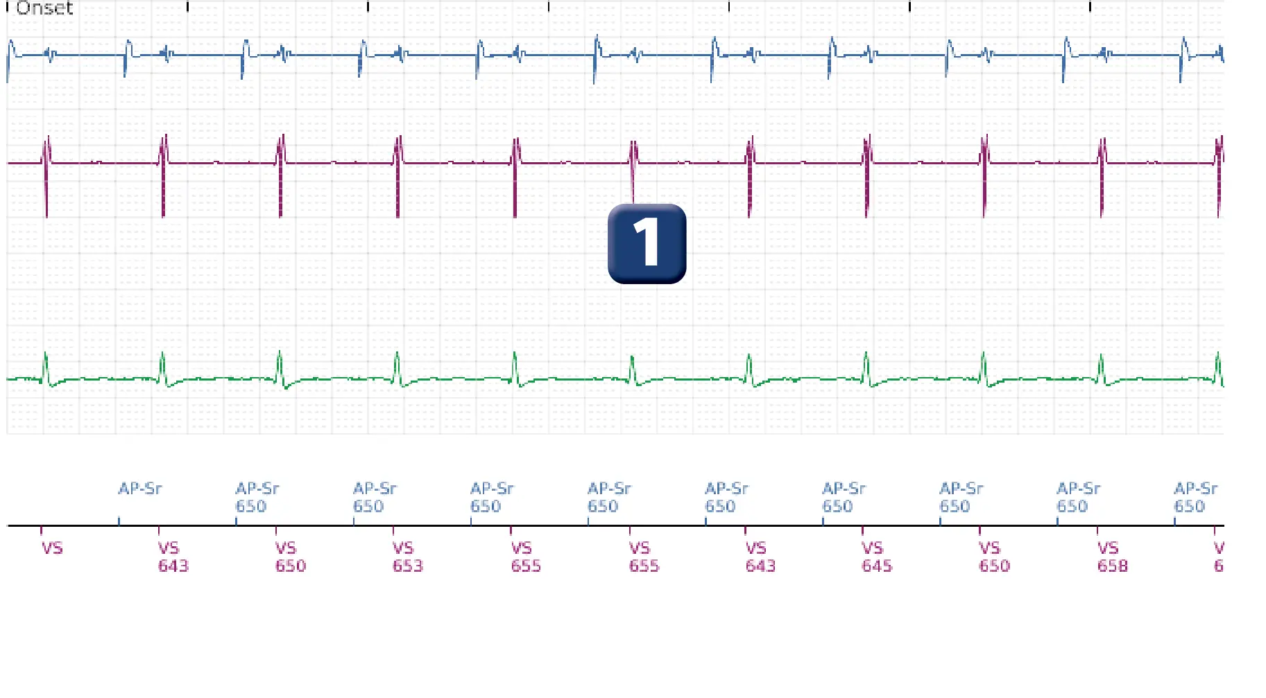 Boston Scientific ICD electrogram, segment 1 of 5 — Undersensing, rate calculation error and ATP burst in the VF zone